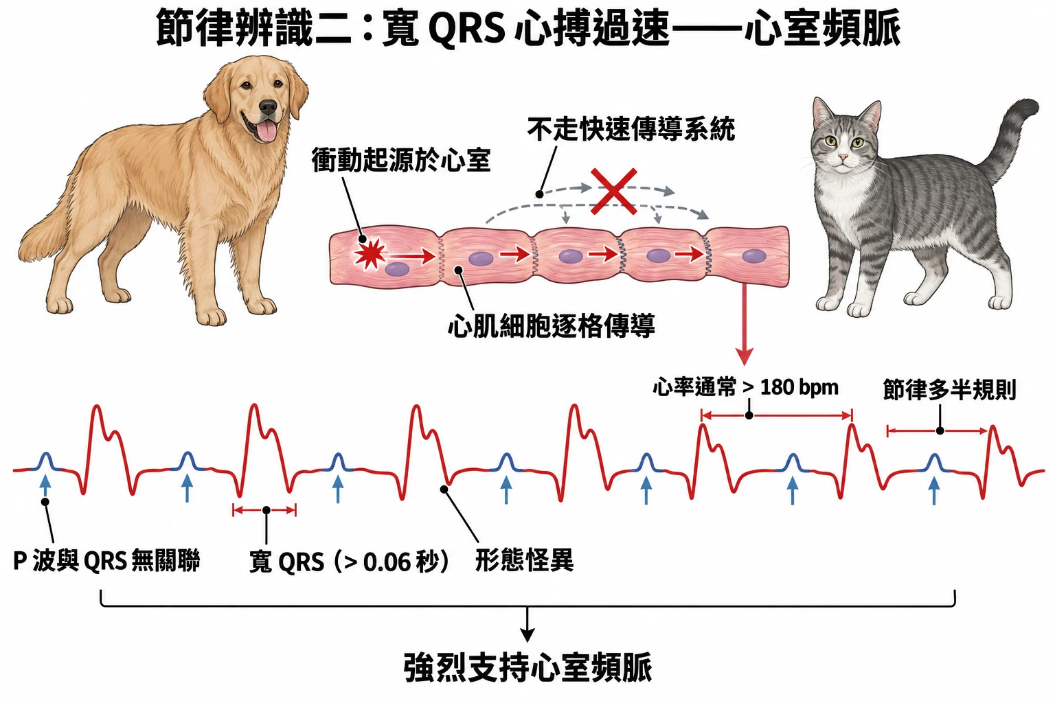 節律辨識二:寬 QRS 心搏過速——心室頻脈教學插圖