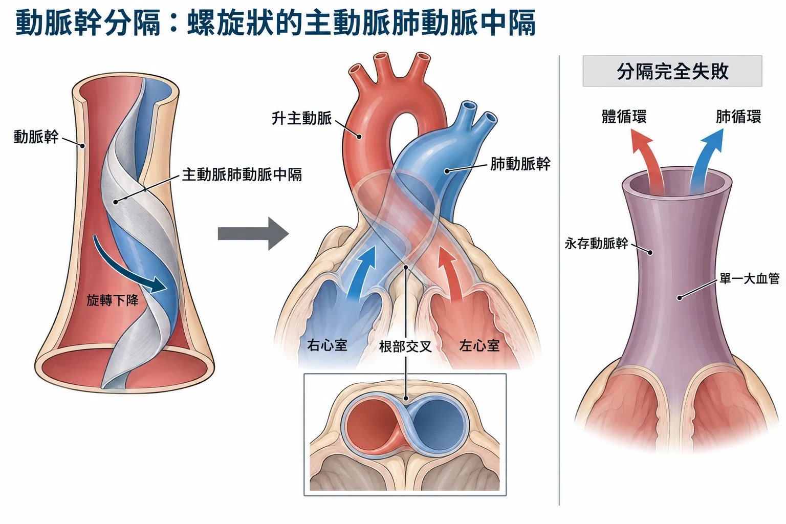 動脈幹分隔:螺旋狀的主動脈肺動脈中隔教學插圖