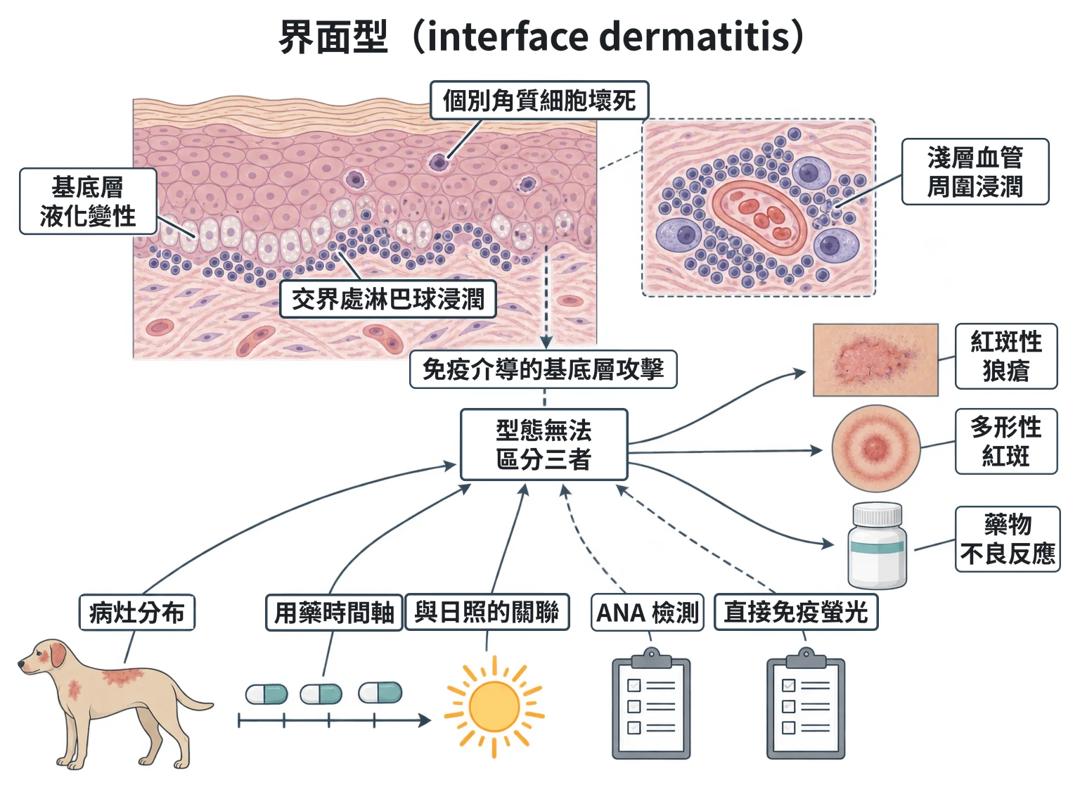界面型(interface dermatitis)教學插圖