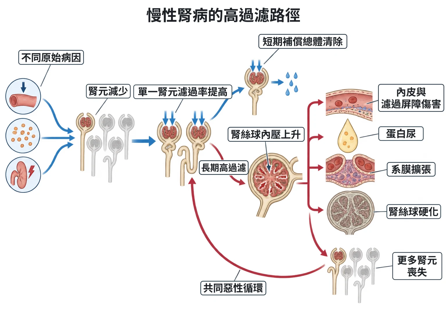 慢性腎病的高過濾路徑教學插圖