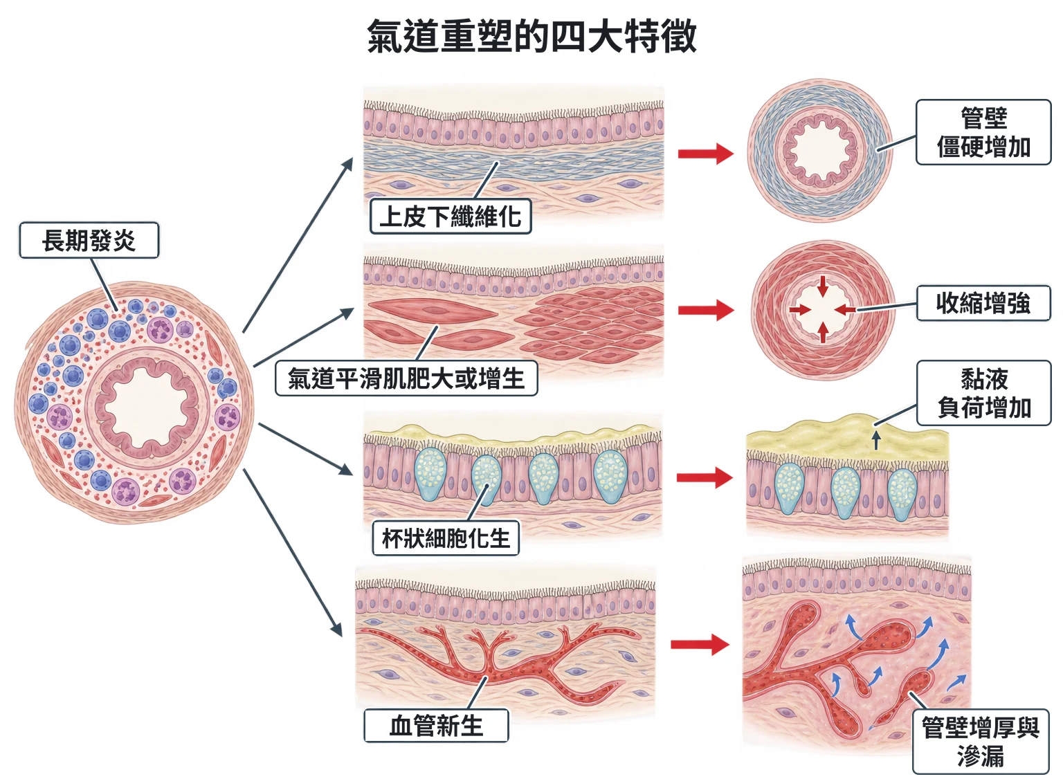 氣道重塑的四大特徵教學插圖