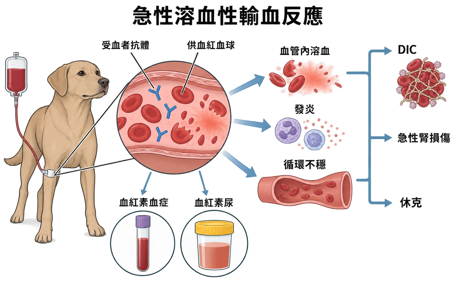 急性溶血性輸血反應教學插圖