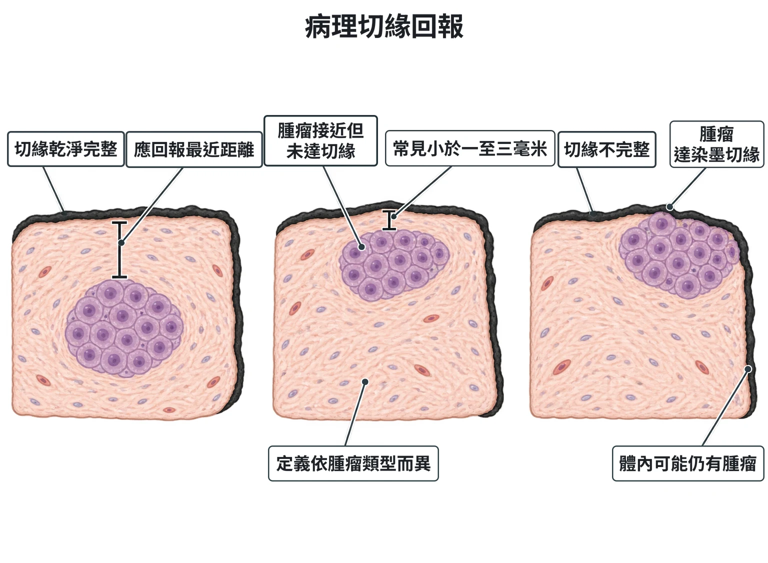 病理切緣回報教學插圖