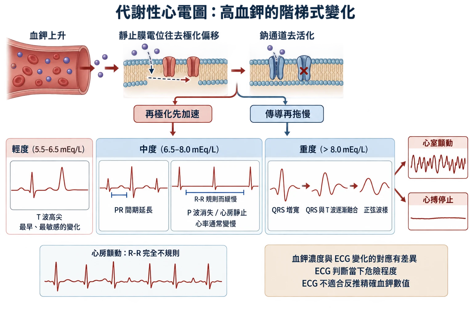 代謝性心電圖:高血鉀的階梯式變化教學插圖