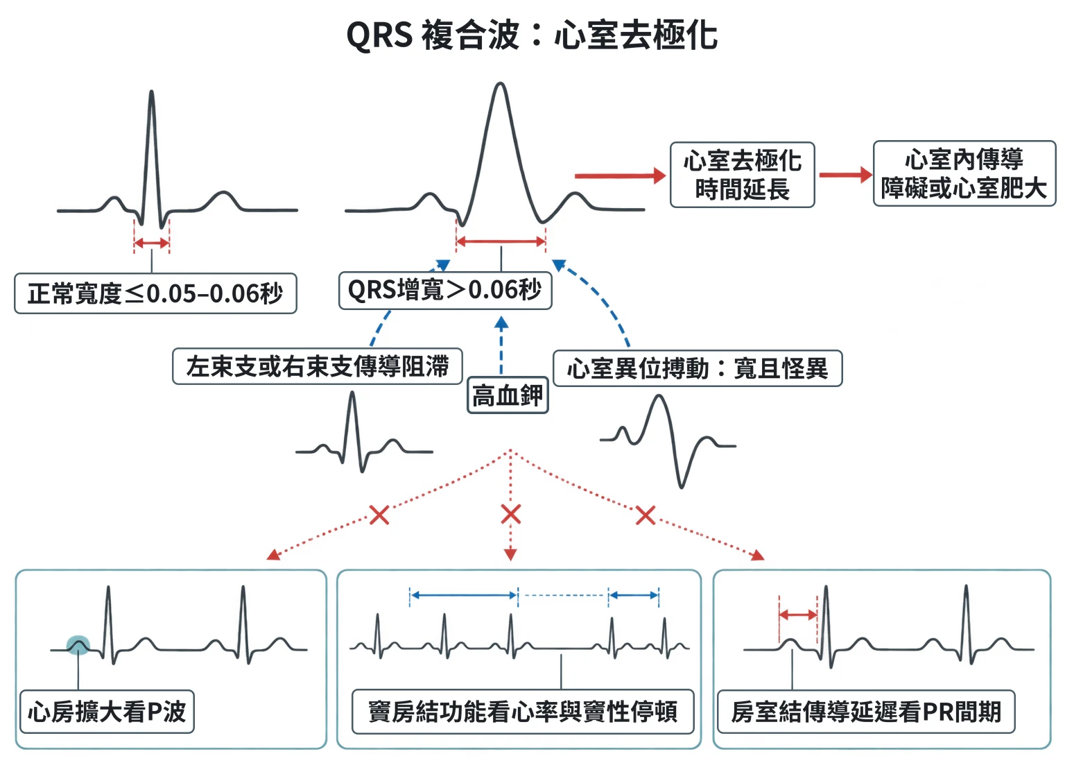 QRS 複合波:心室去極化教學插圖