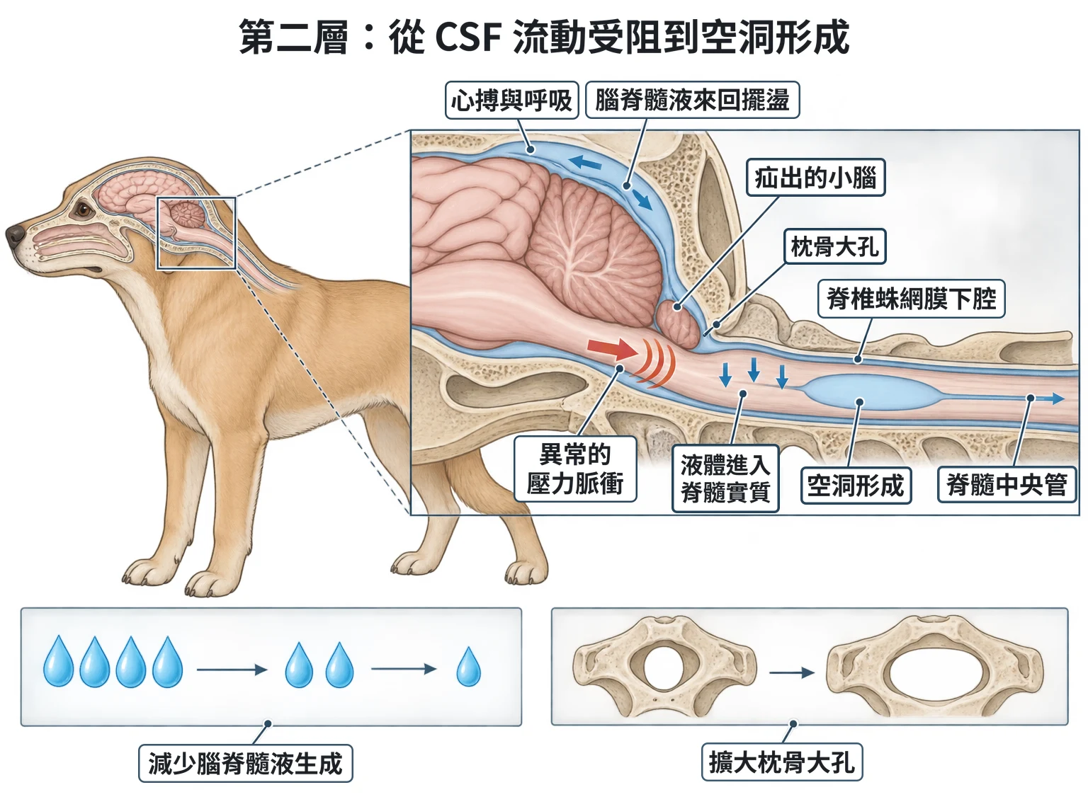 第二層:從 CSF 流動受阻到空洞形成教學插圖