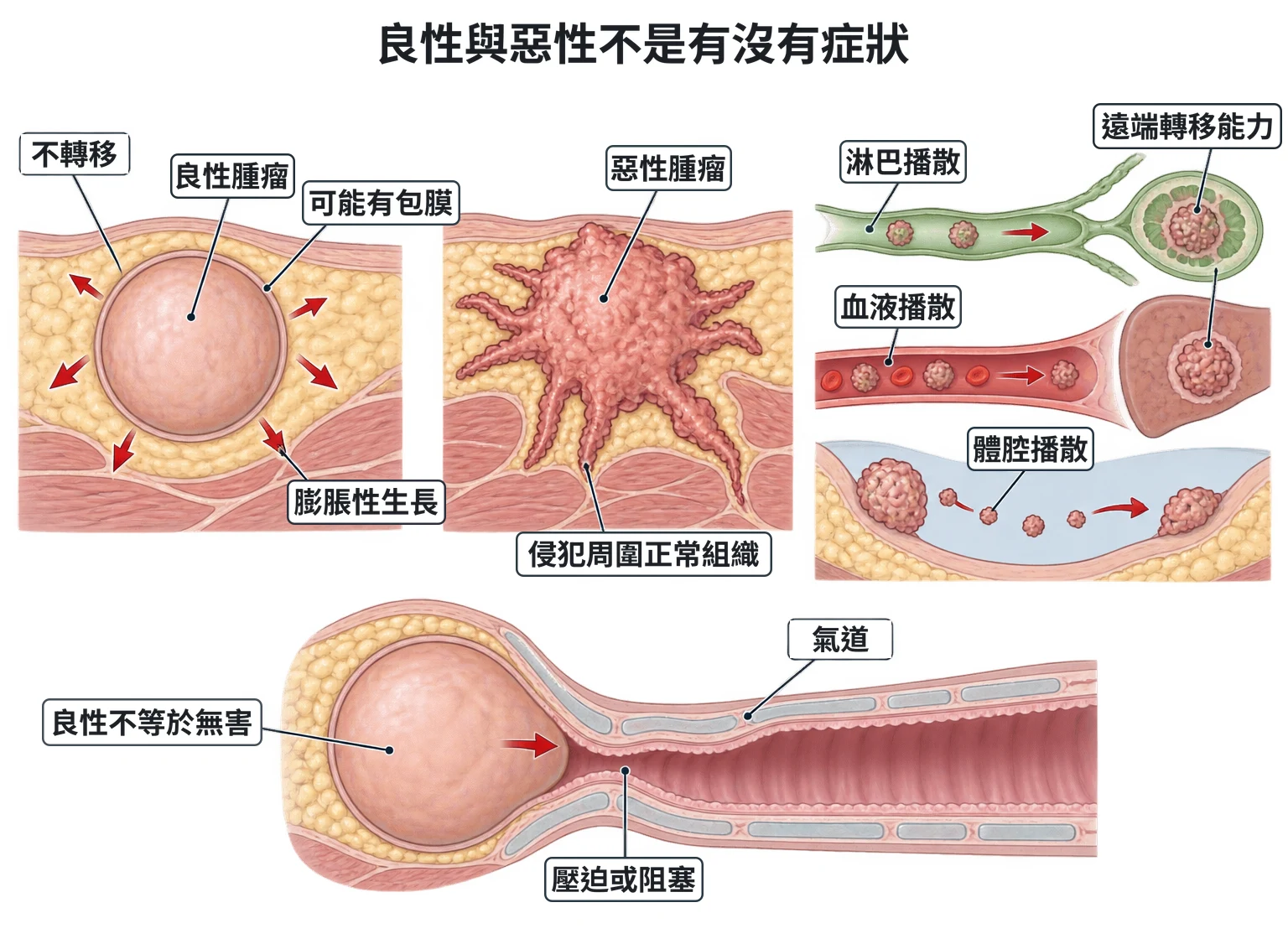 良性與惡性不是有沒有症狀教學插圖