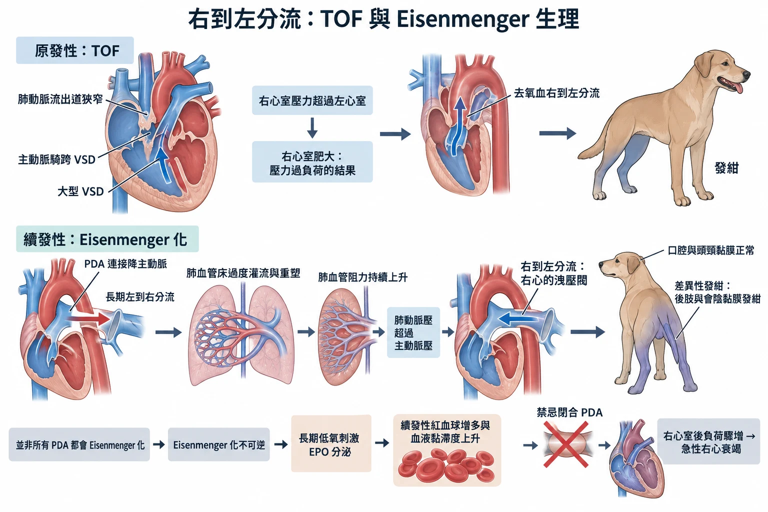 右到左分流:TOF 與 Eisenmenger 生理教學插圖