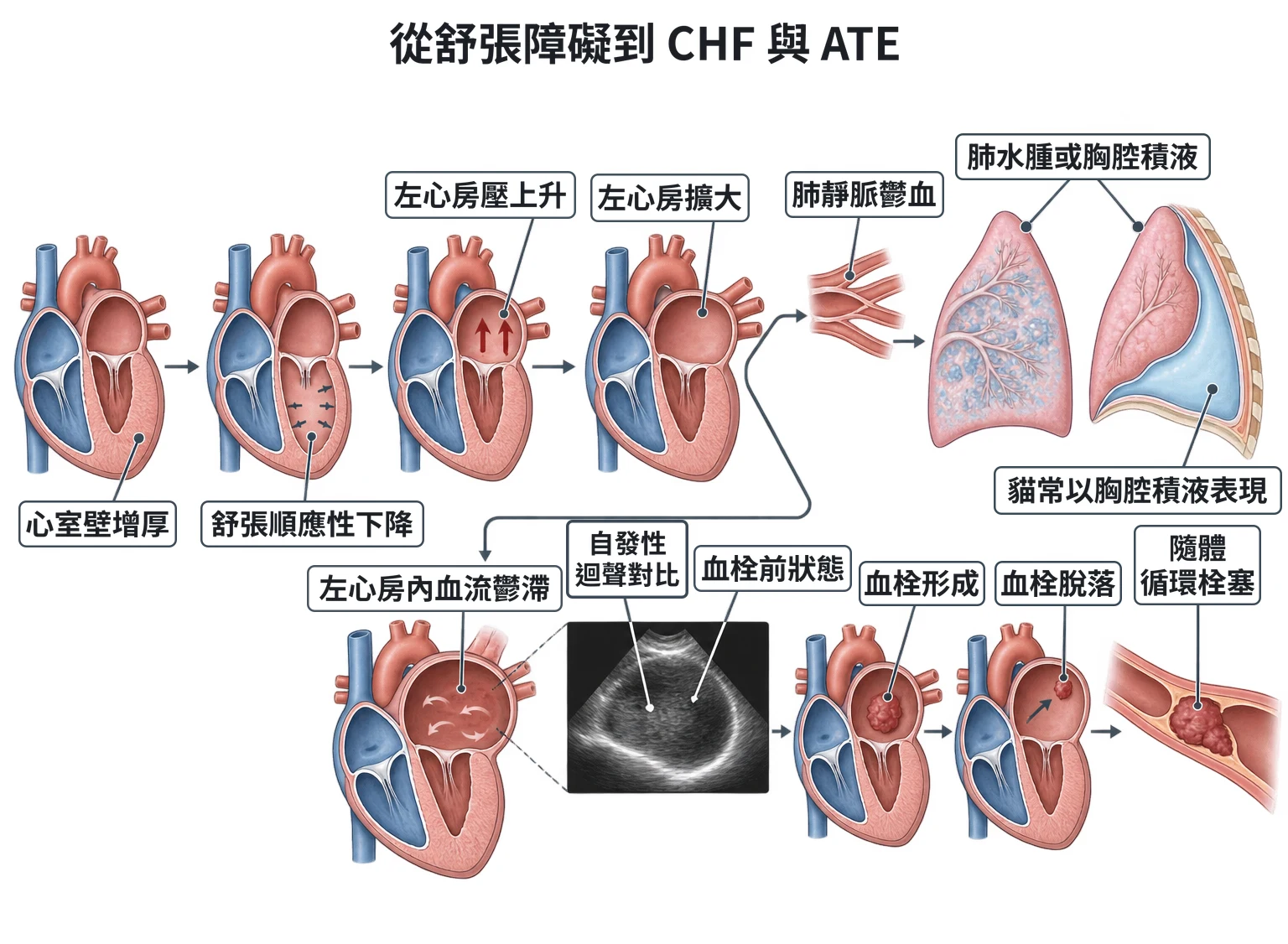 從舒張障礙到 CHF 與 ATE教學插圖