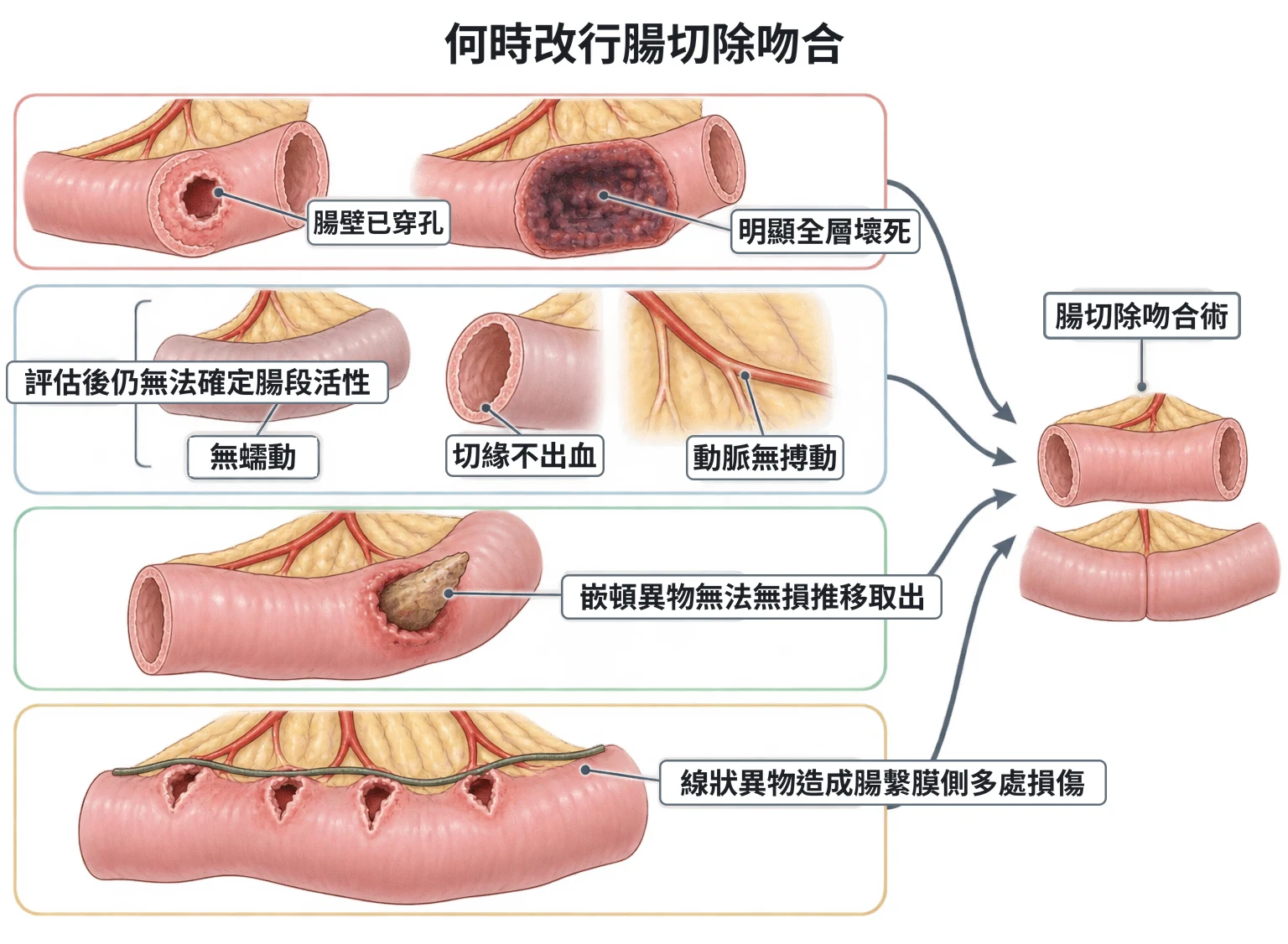 何時改行腸切除吻合教學插圖