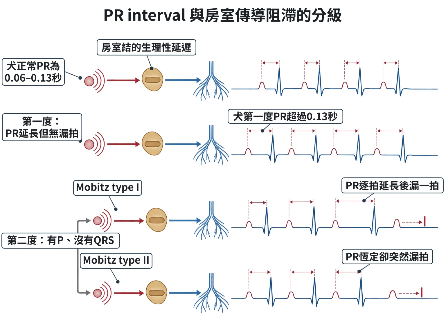 PR interval 與房室傳導阻滯的分級教學插圖