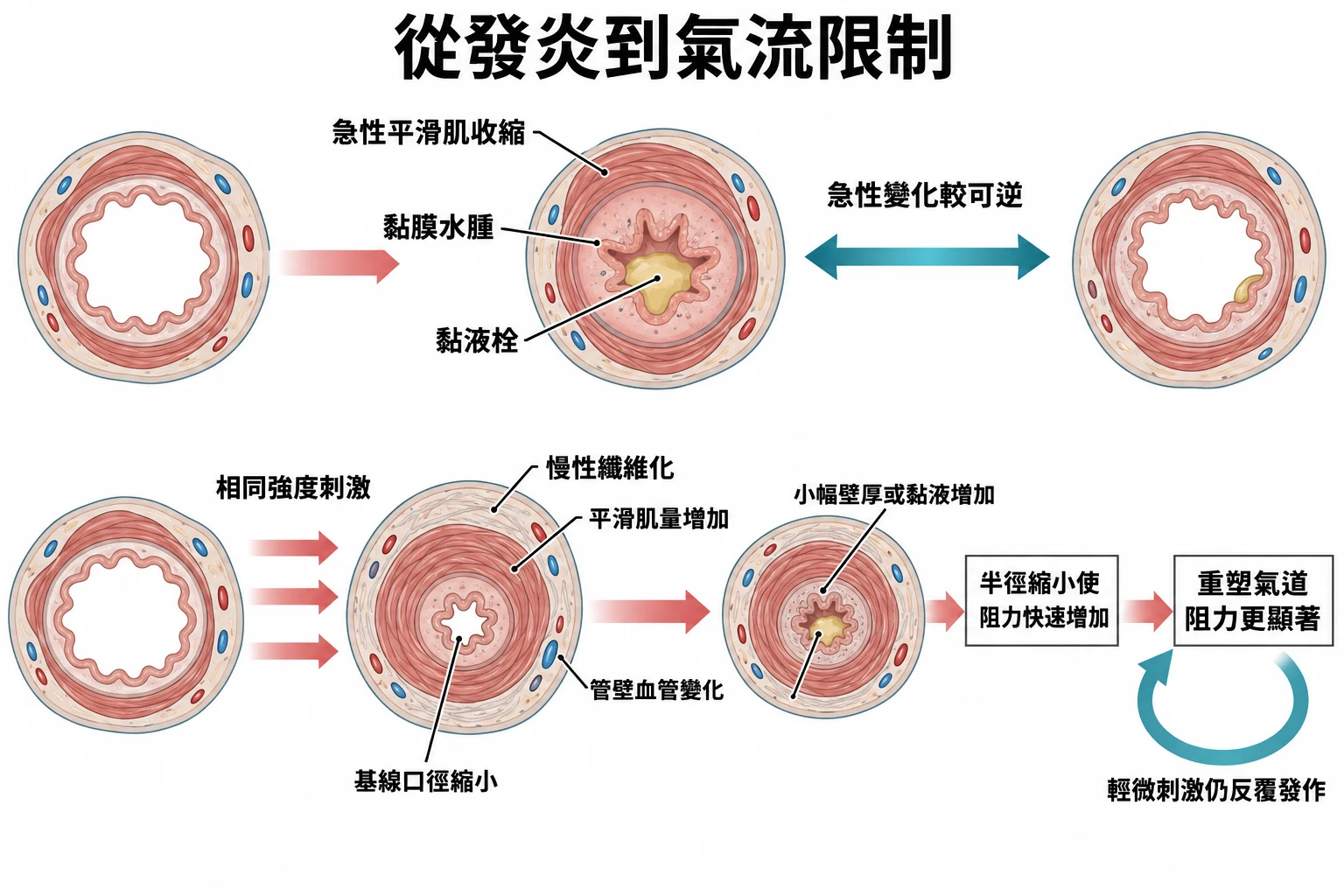 從發炎到氣流限制教學插圖