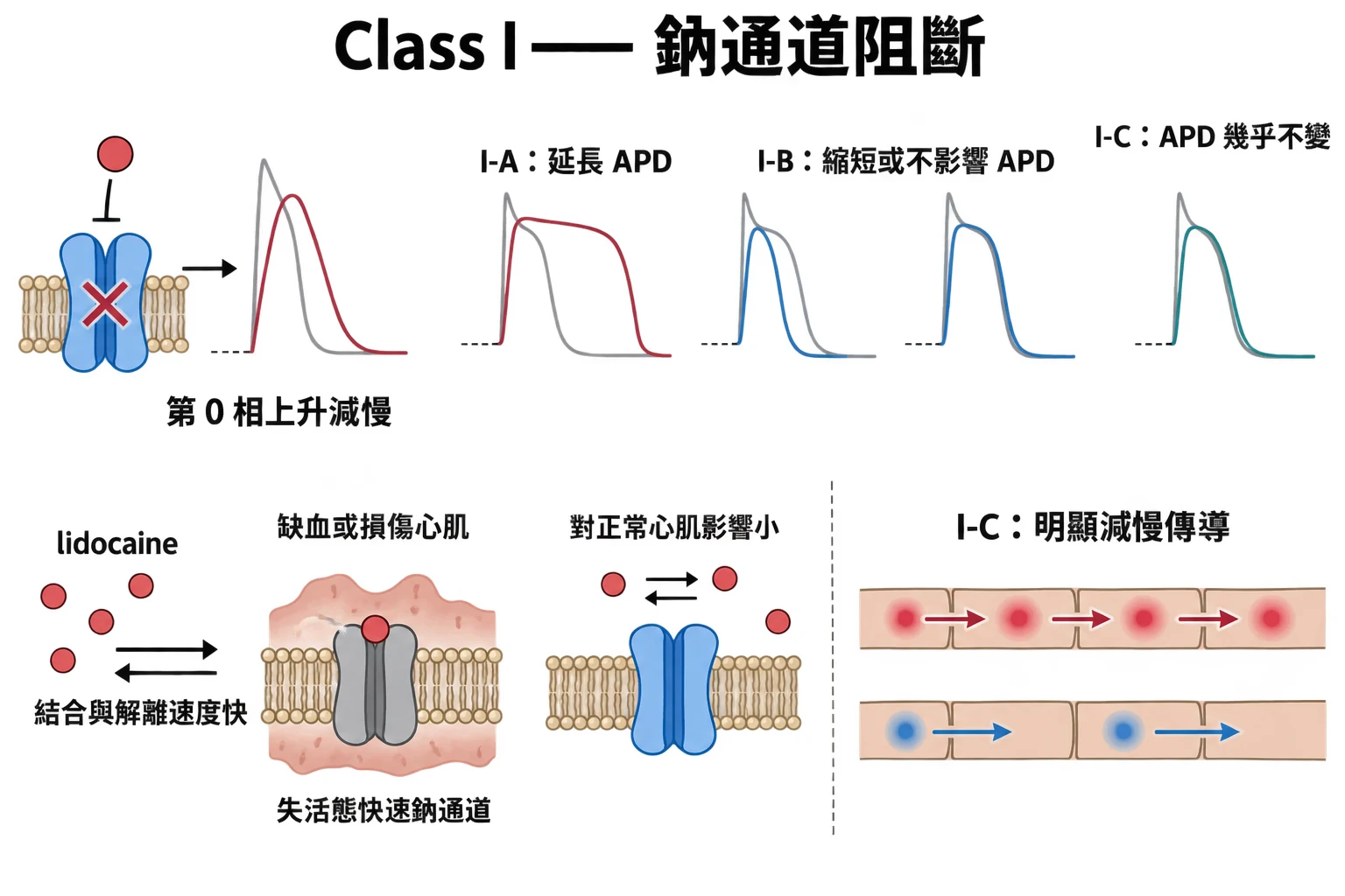 Class I —— 鈉通道阻斷教學插圖