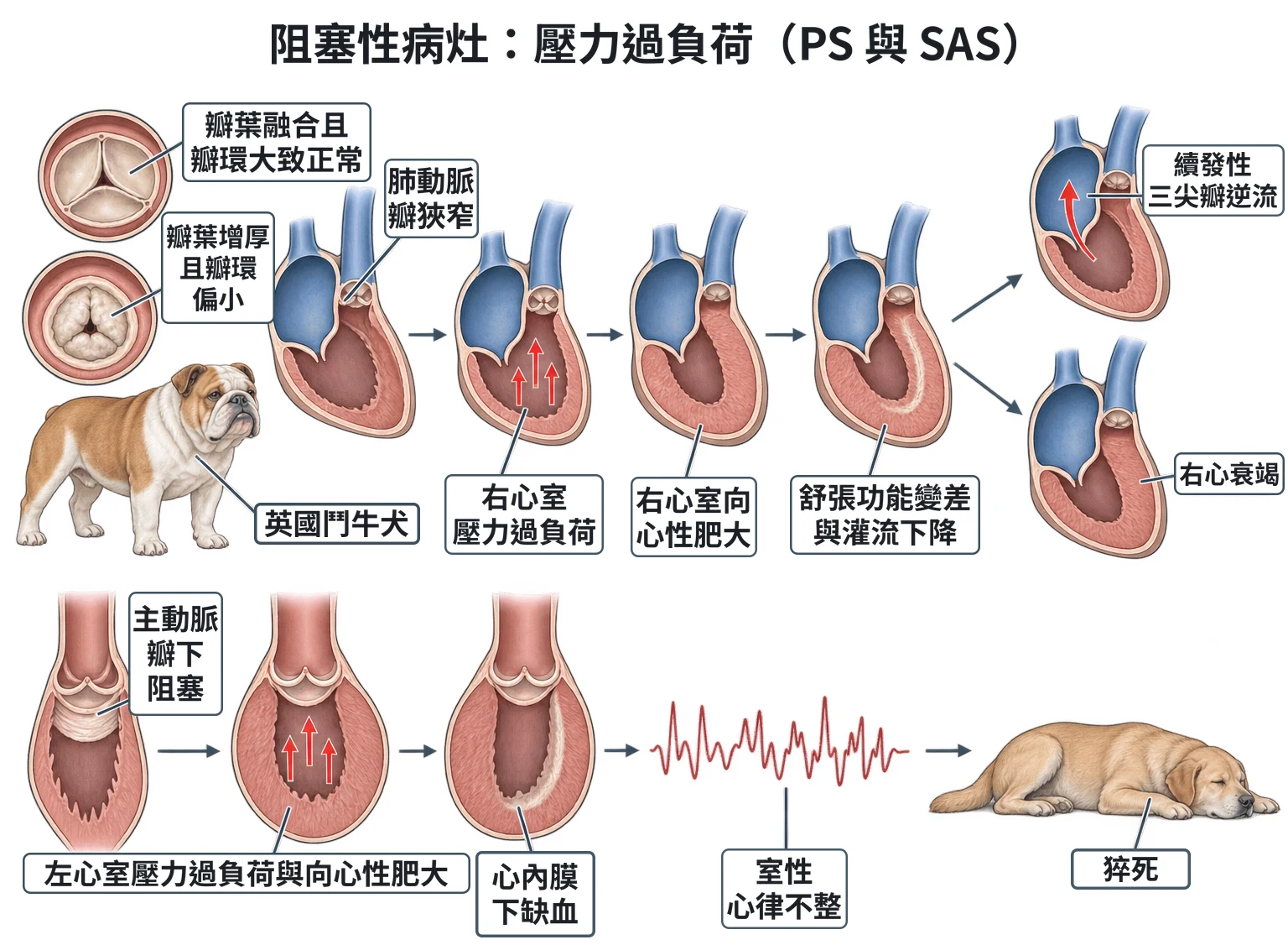 阻塞性病灶:壓力過負荷(PS 與 SAS)教學插圖