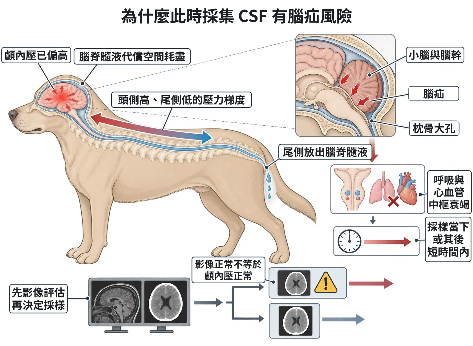 為什麼此時採集 CSF 有腦疝風險教學插圖