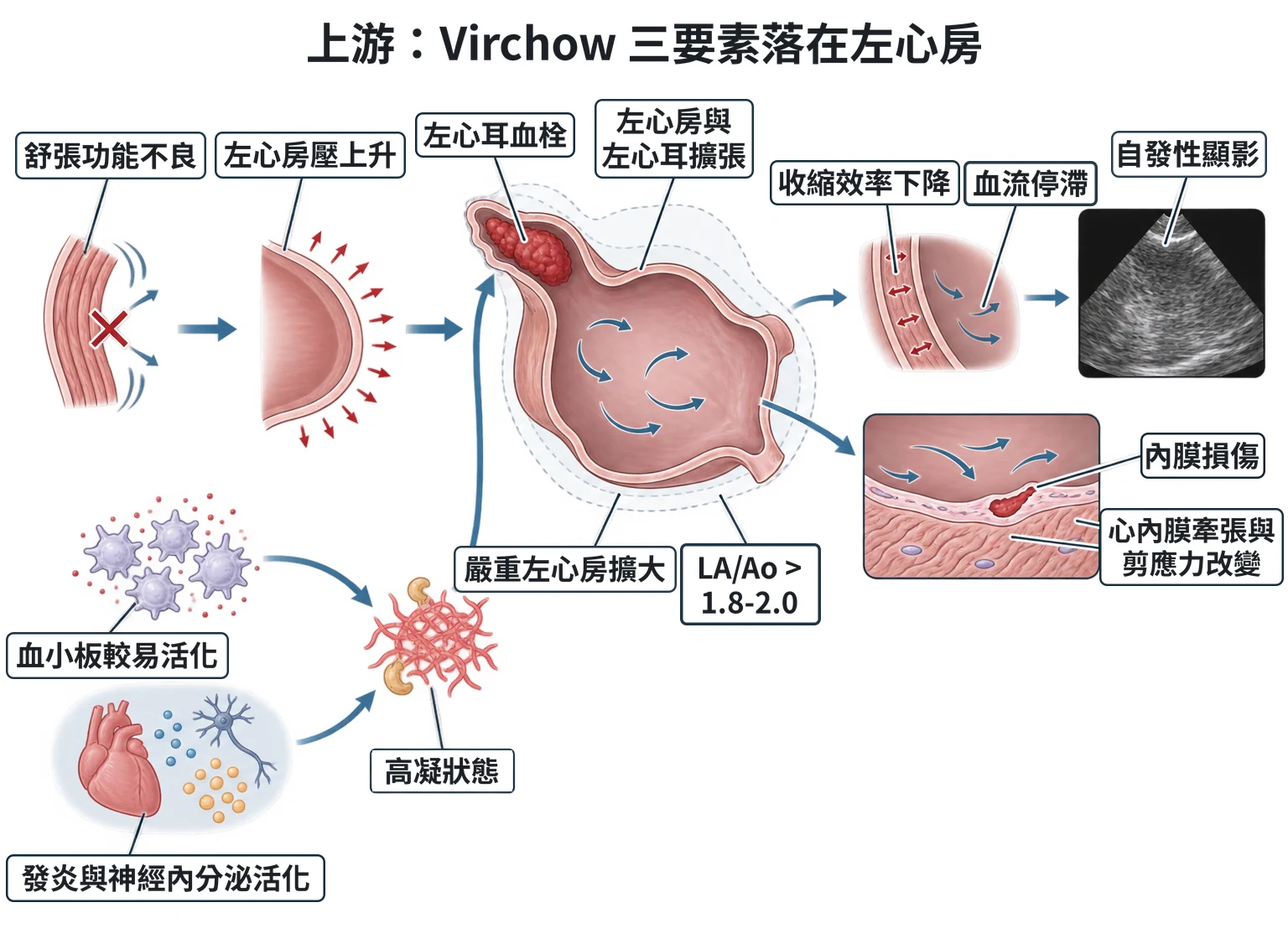 上游:Virchow 三要素落在左心房教學插圖