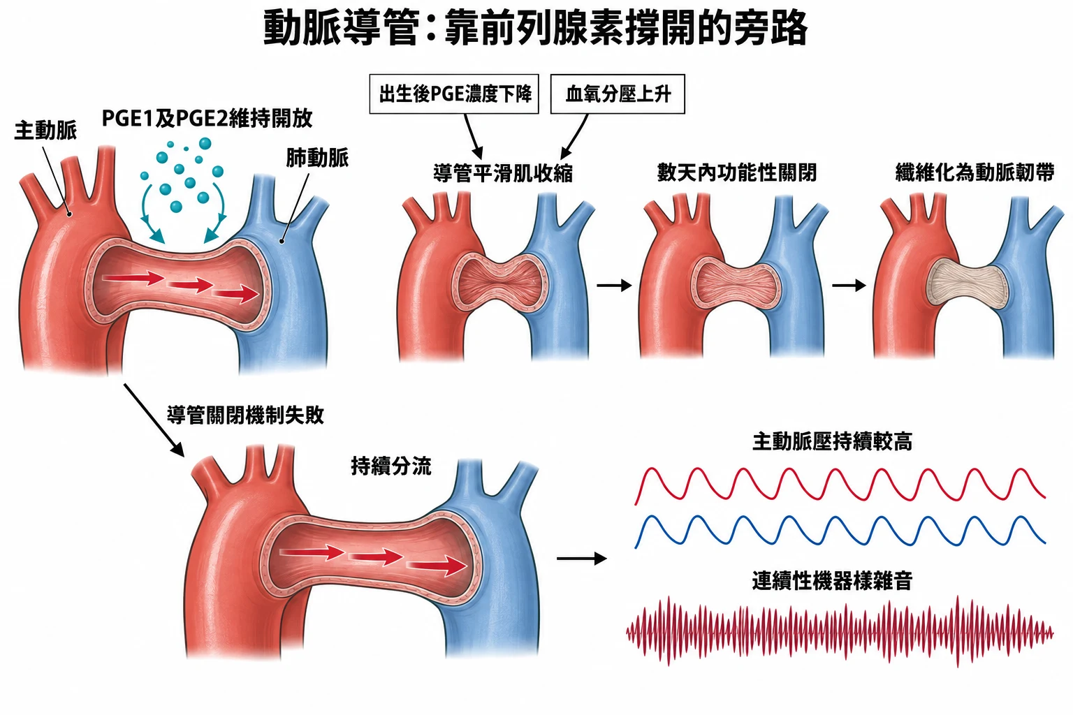 動脈導管:靠前列腺素撐開的旁路教學插圖