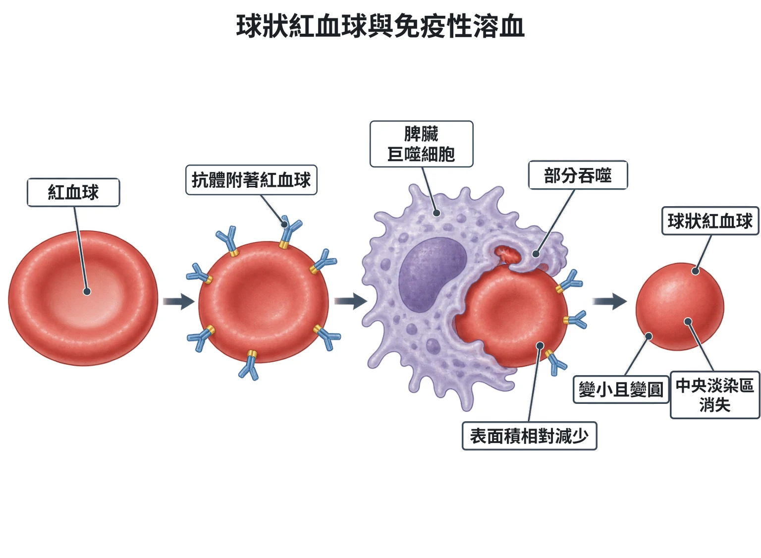 球狀紅血球與免疫性溶血教學插圖