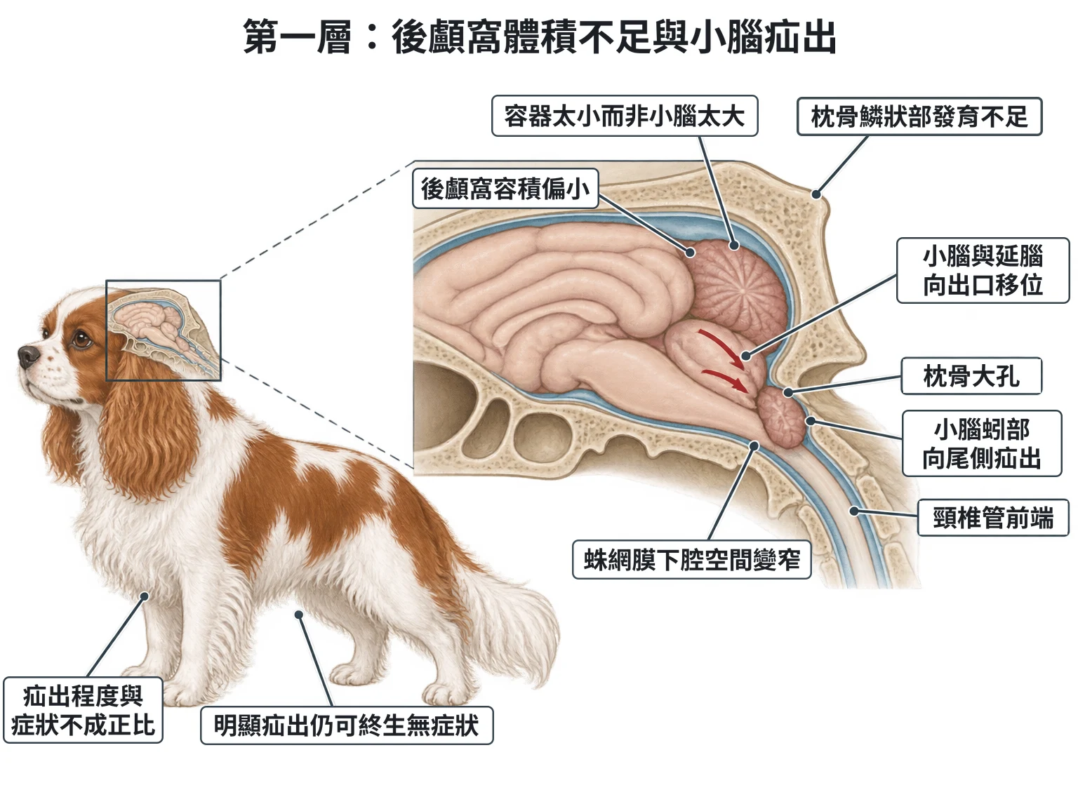 第一層:後顱窩體積不足與小腦疝出教學插圖
