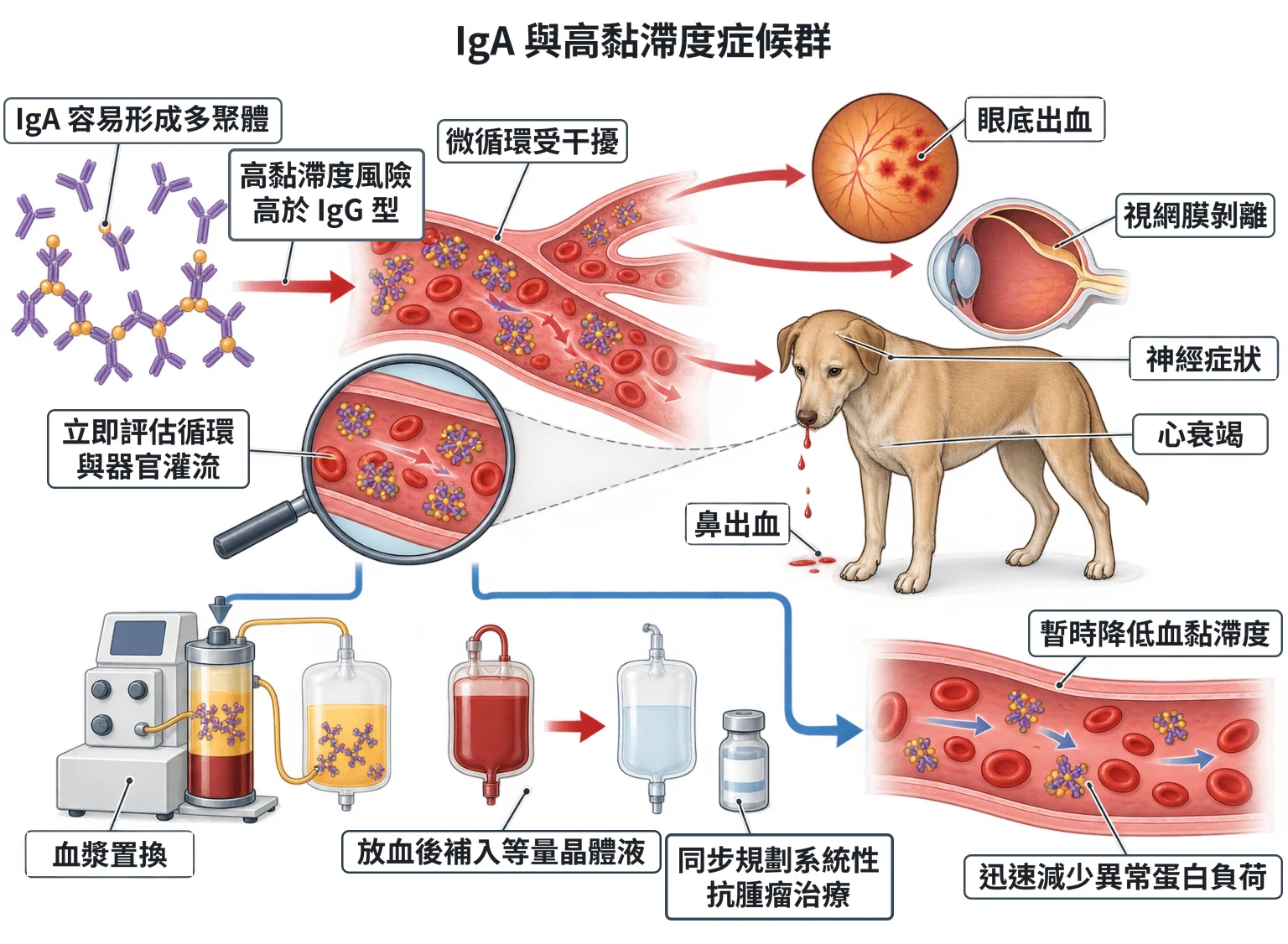 IgA 與高黏滯度症候群教學插圖