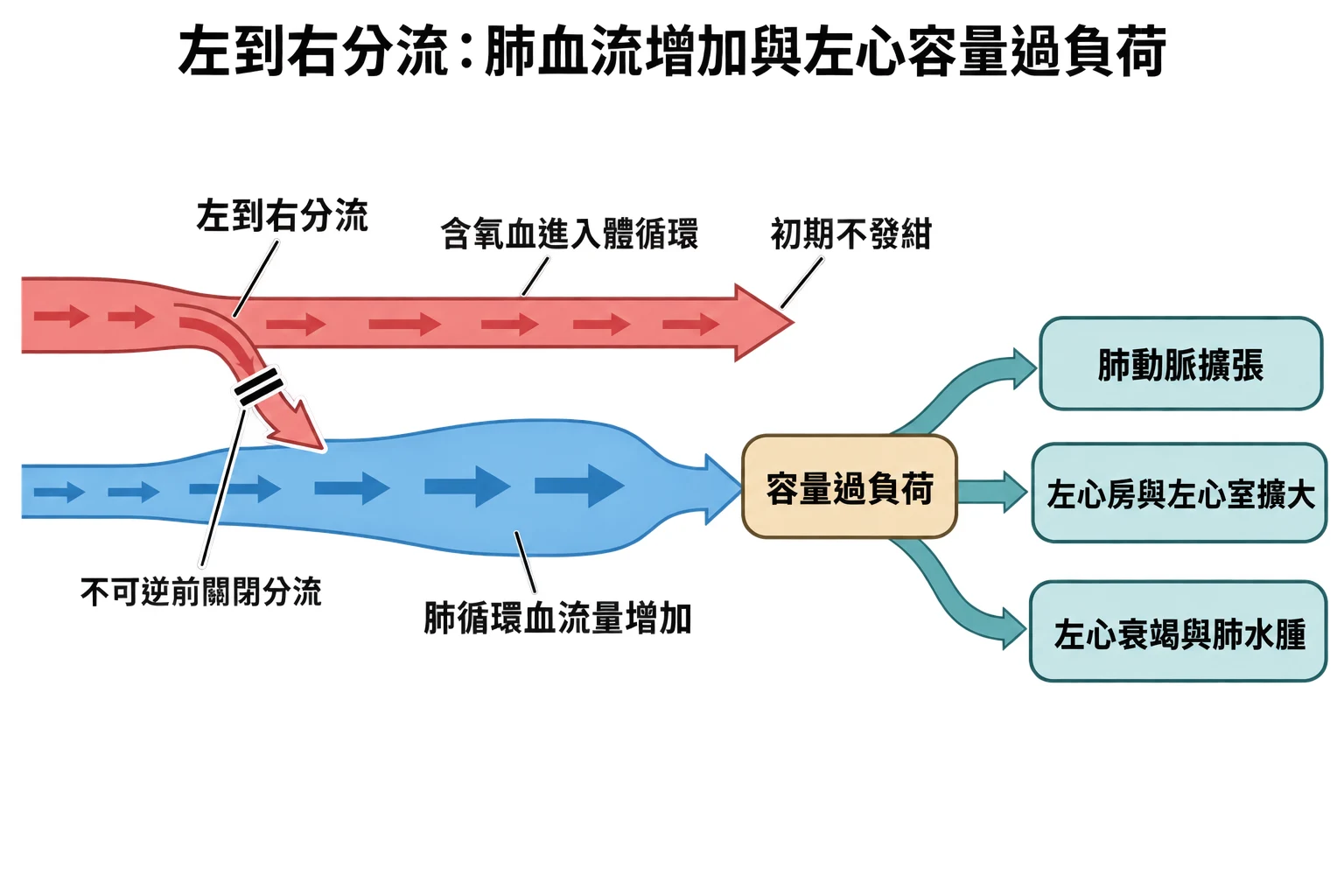 左到右分流:肺血流增加與左心容量過負荷教學插圖