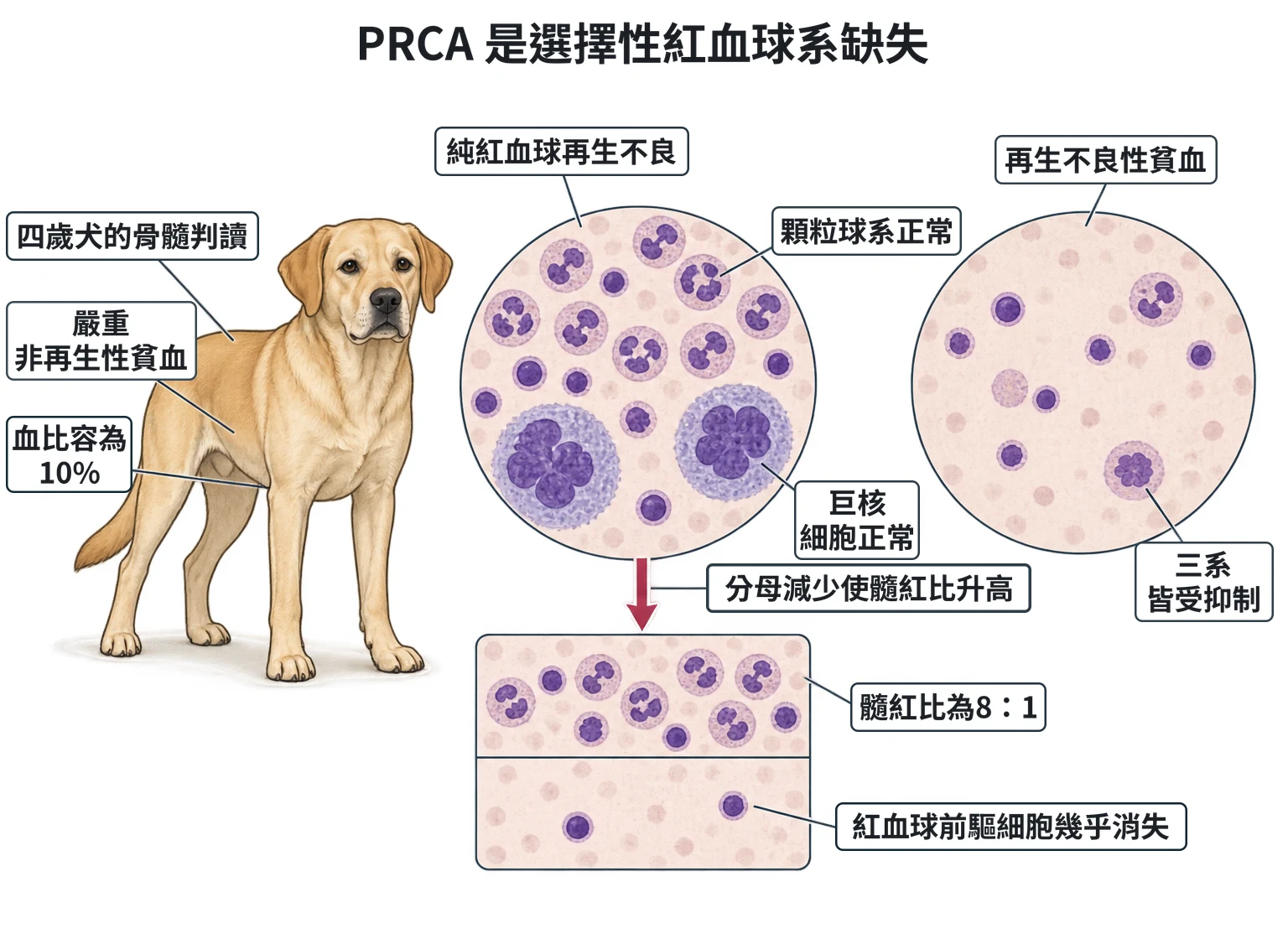 PRCA 是選擇性紅血球系缺失教學插圖