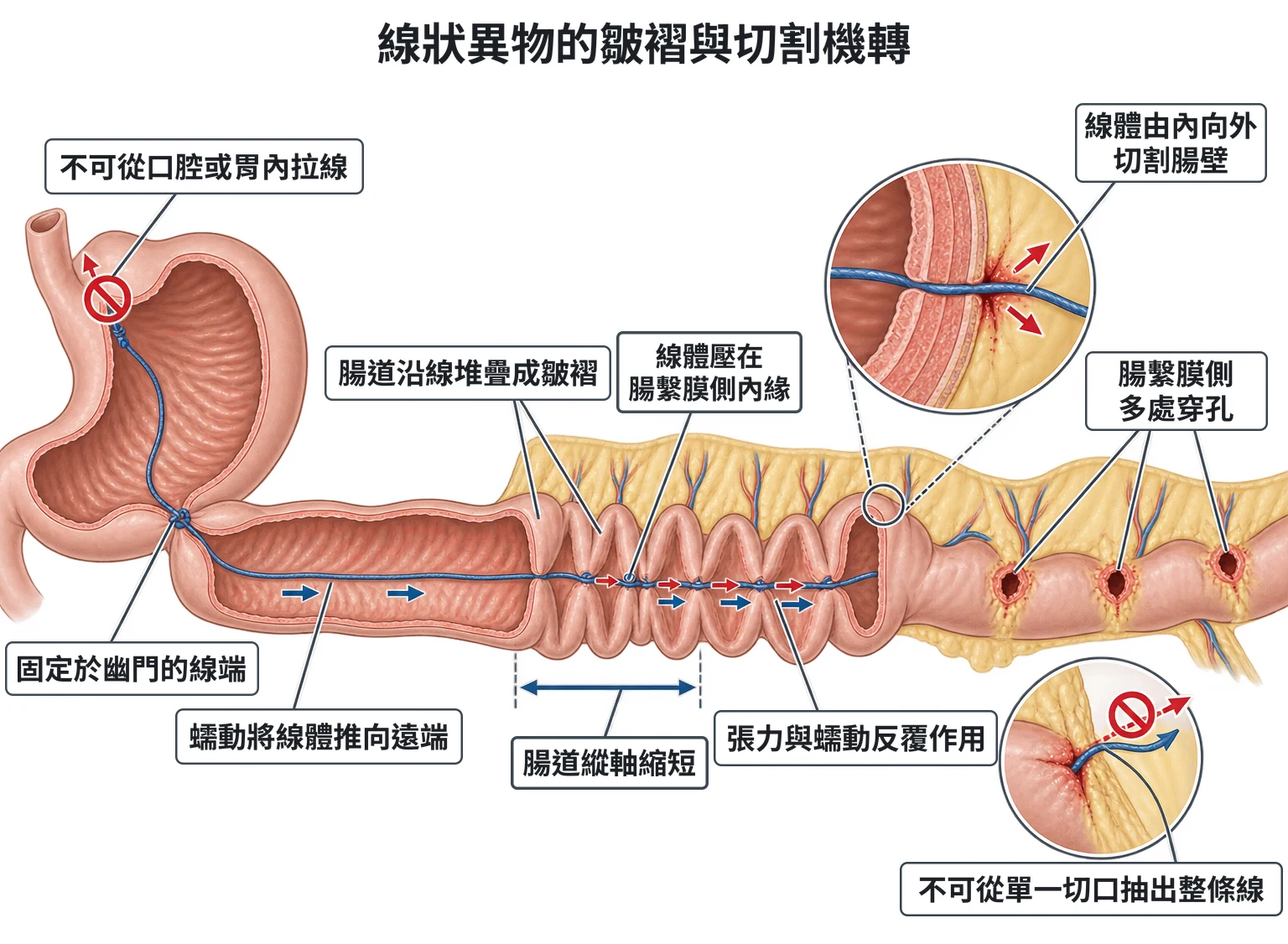 線狀異物的皺褶與切割機轉教學插圖