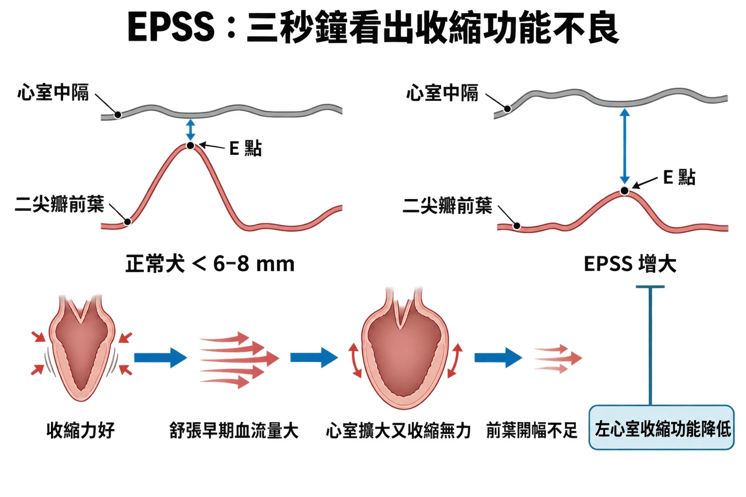 EPSS:三秒鐘看出收縮功能不良教學插圖
