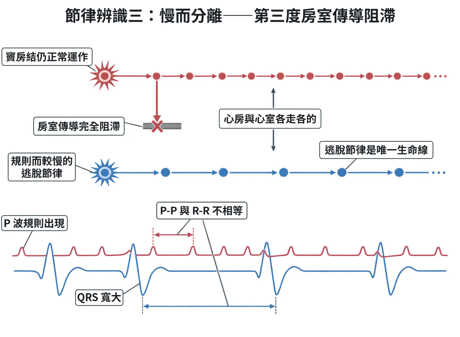 節律辨識三:慢而分離——第三度房室傳導阻滯教學插圖