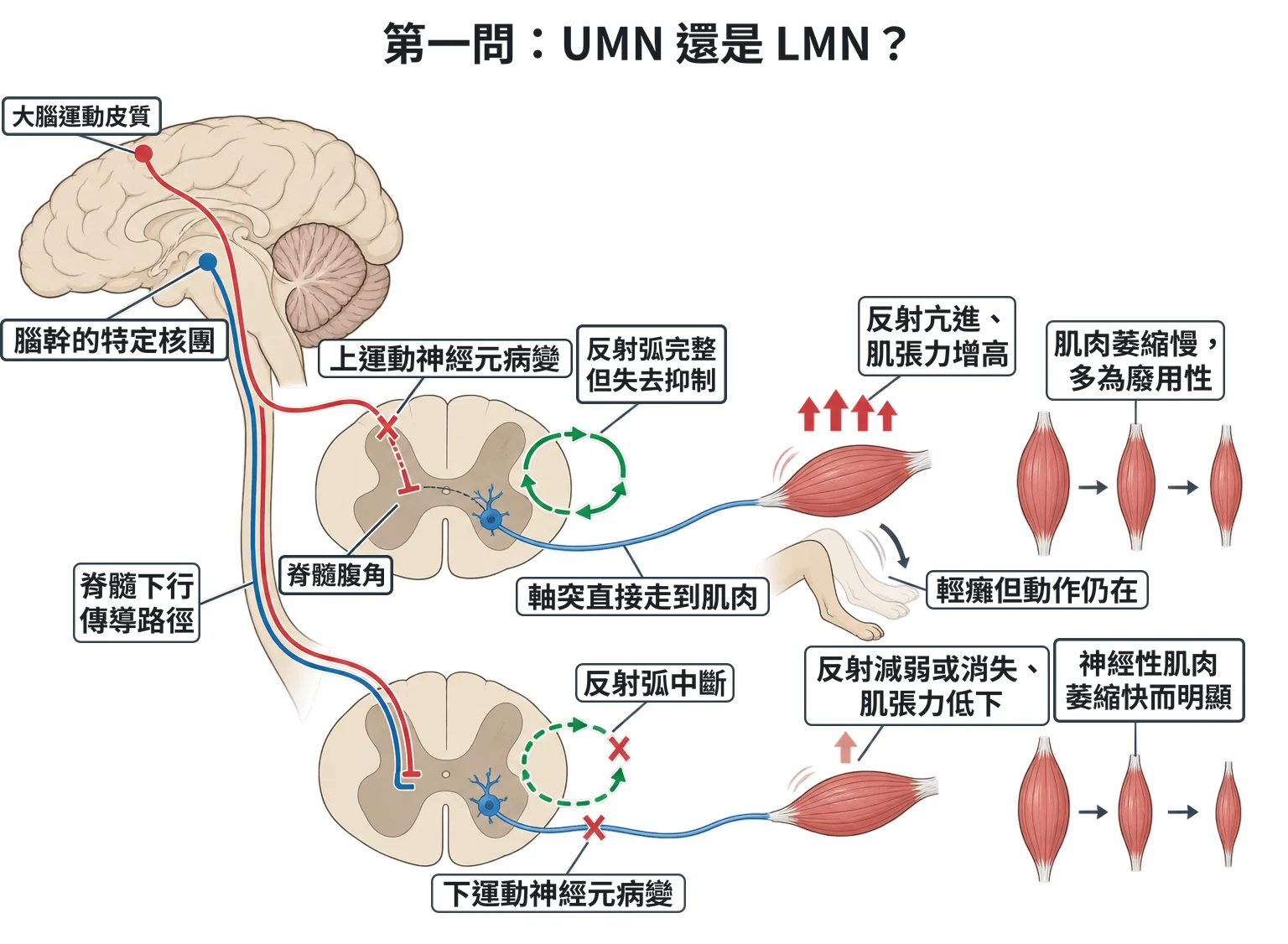 第一問:UMN 還是 LMN?教學插圖