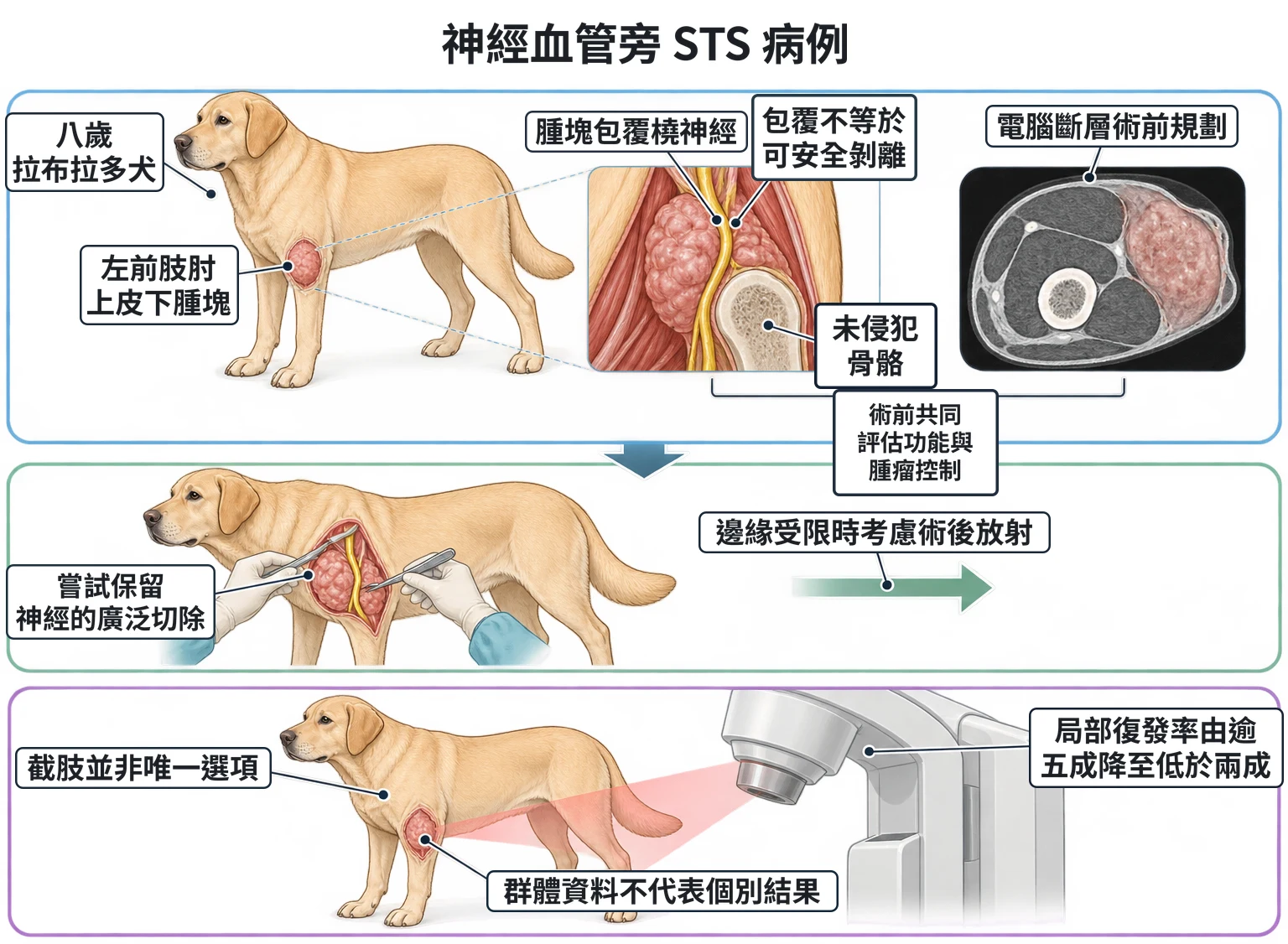 神經血管旁 STS 病例教學插圖
