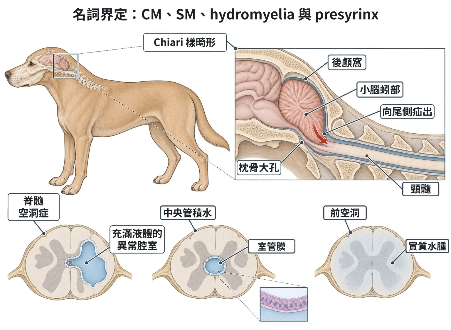 名詞界定:CM、SM、hydromyelia 與 presyrinx教學插圖