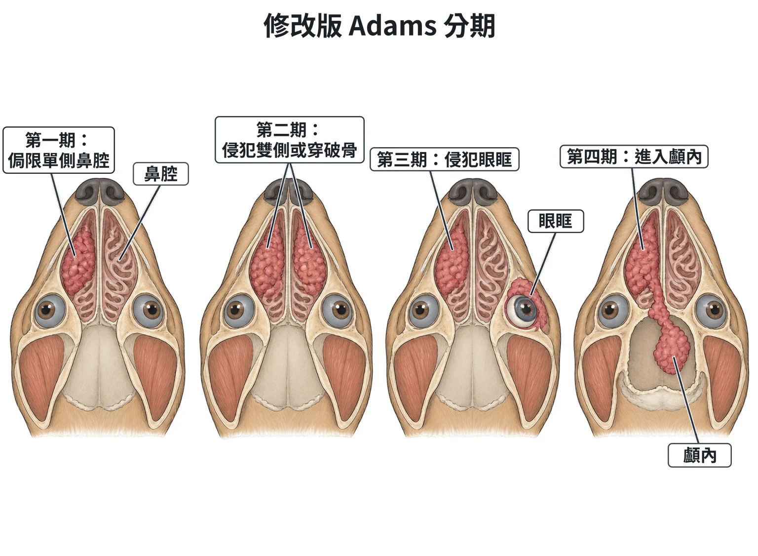 修改版 Adams 分期教學插圖