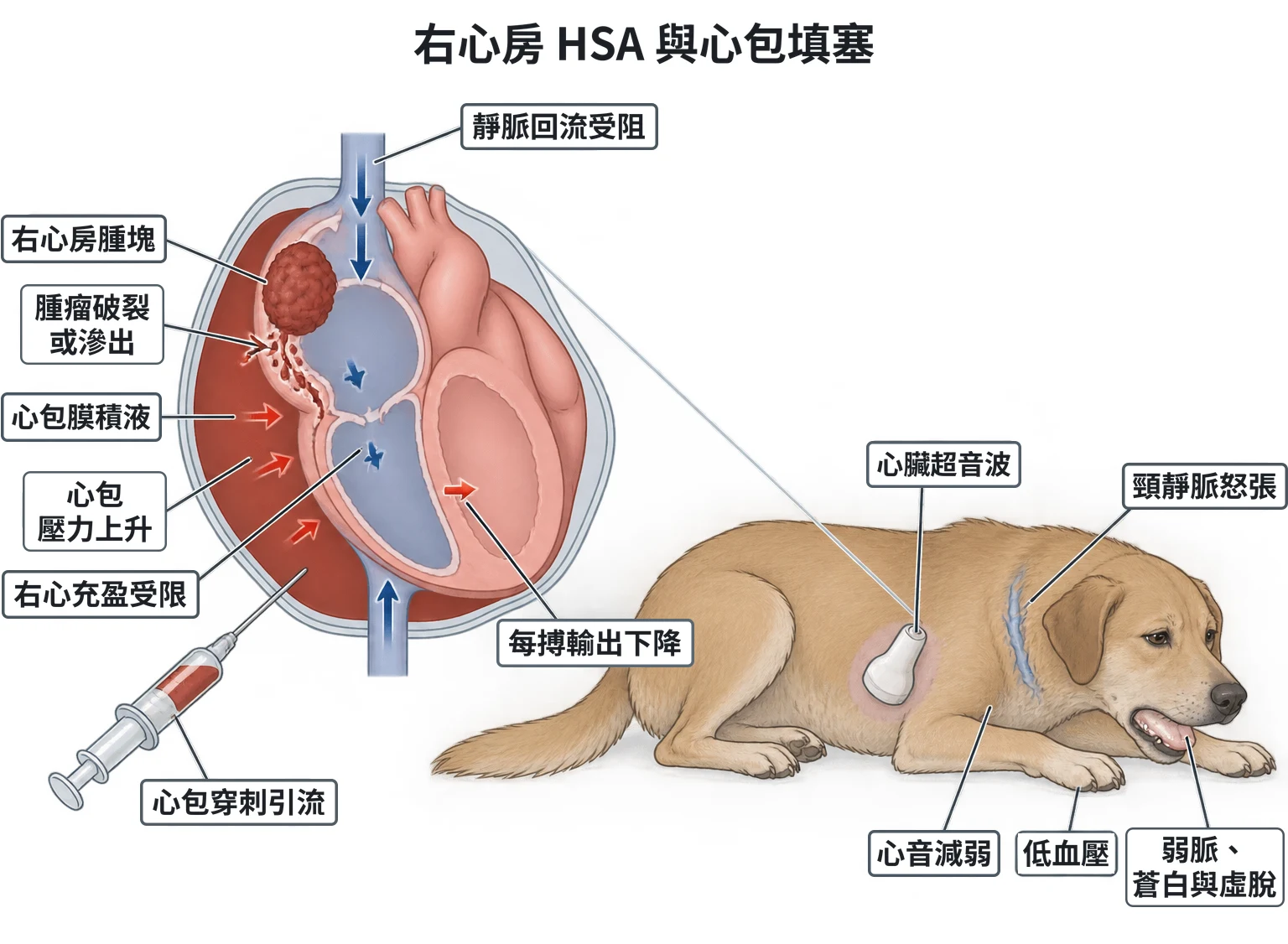 右心房 HSA 與心包填塞教學插圖