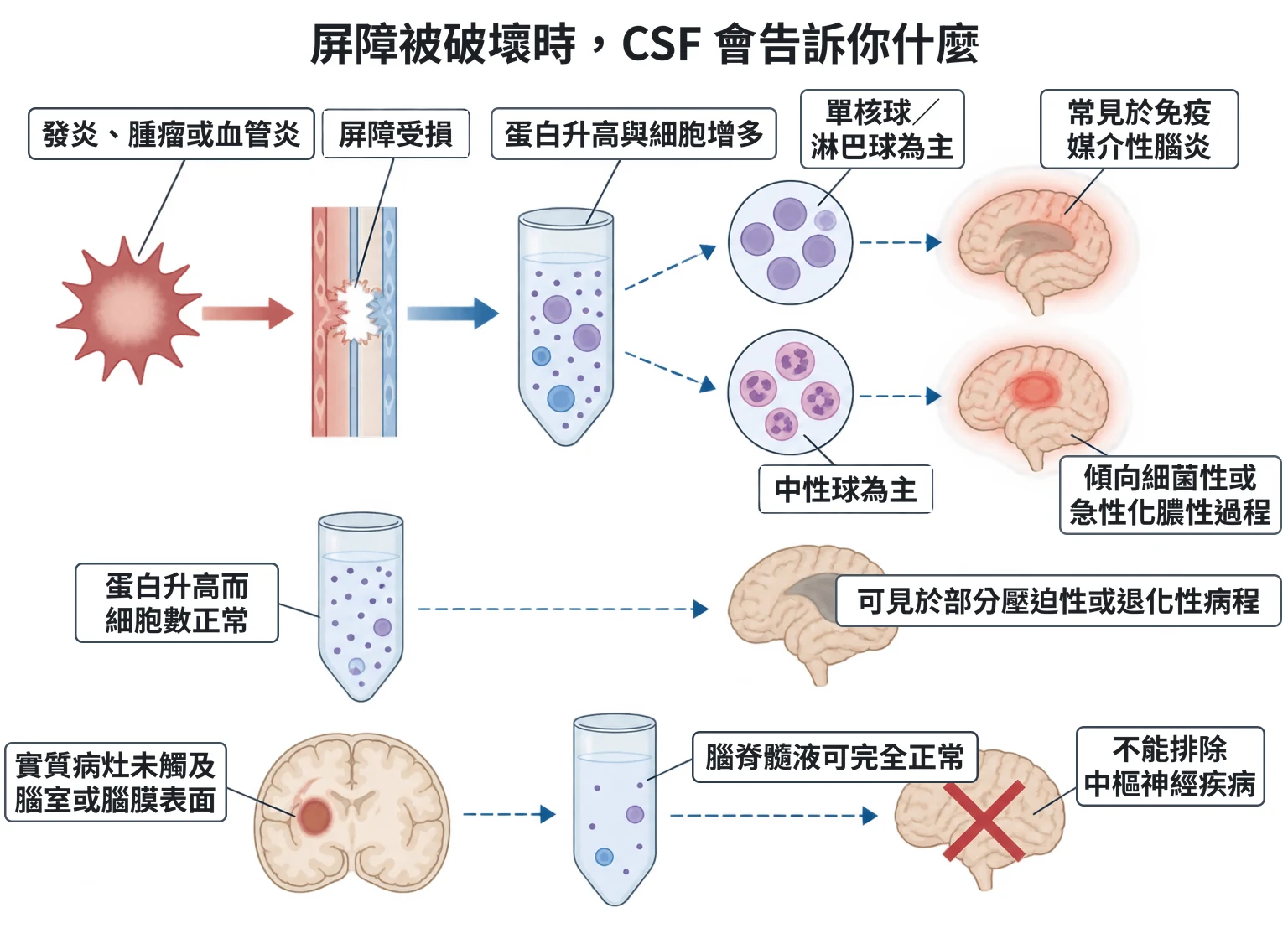 屏障被破壞時,CSF 會告訴你什麼教學插圖