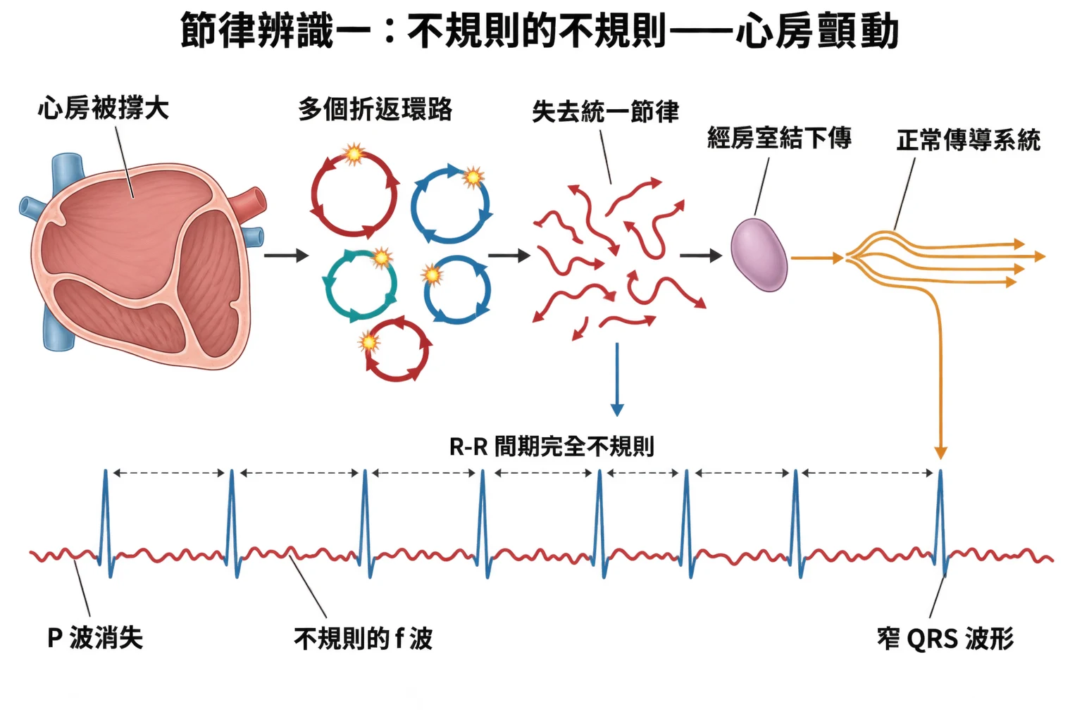 節律辨識一:不規則的不規則——心房顫動教學插圖