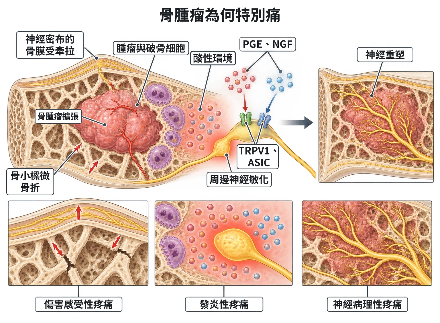 骨腫瘤為何特別痛教學插圖