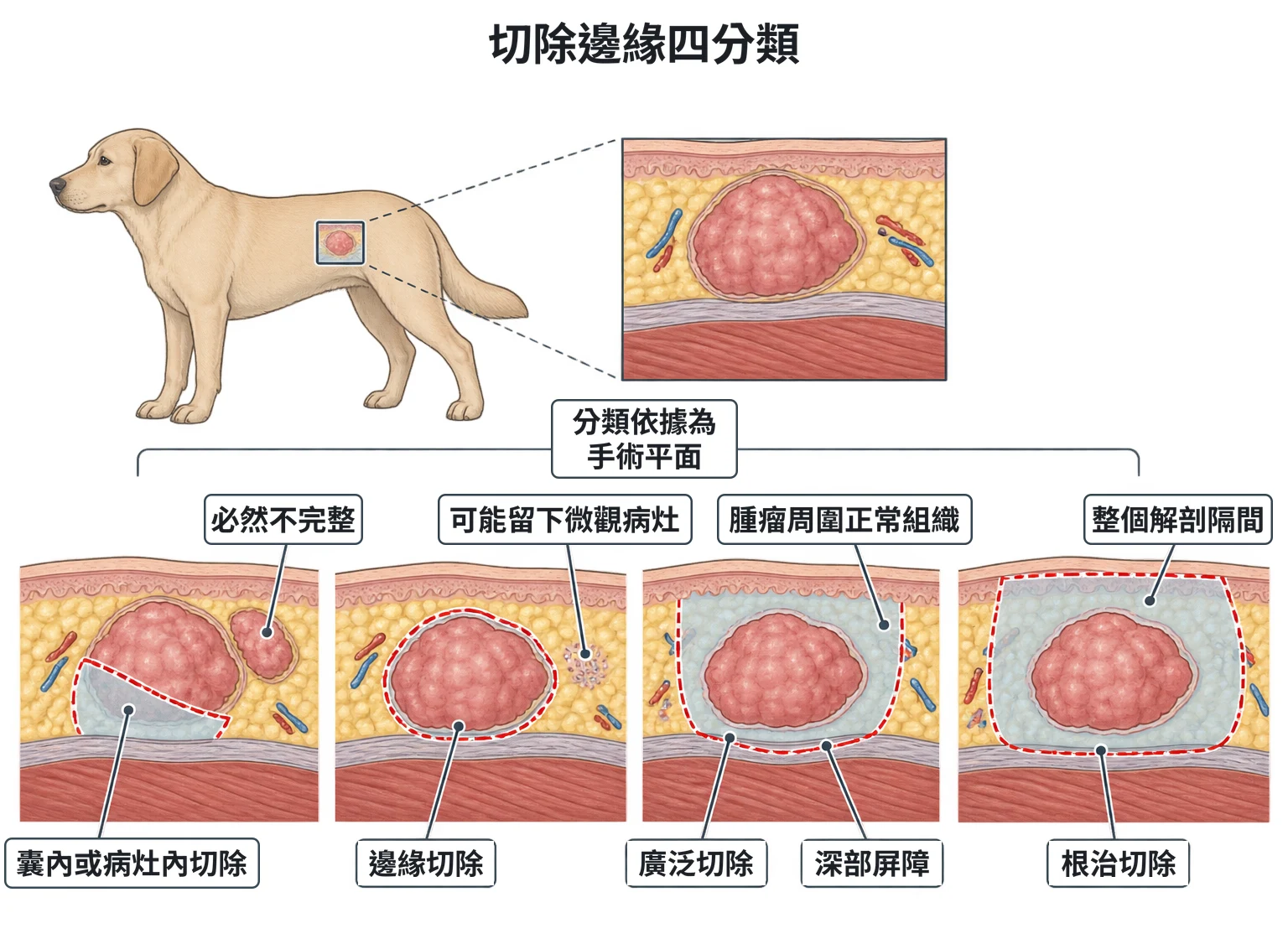 切除邊緣四分類教學插圖
