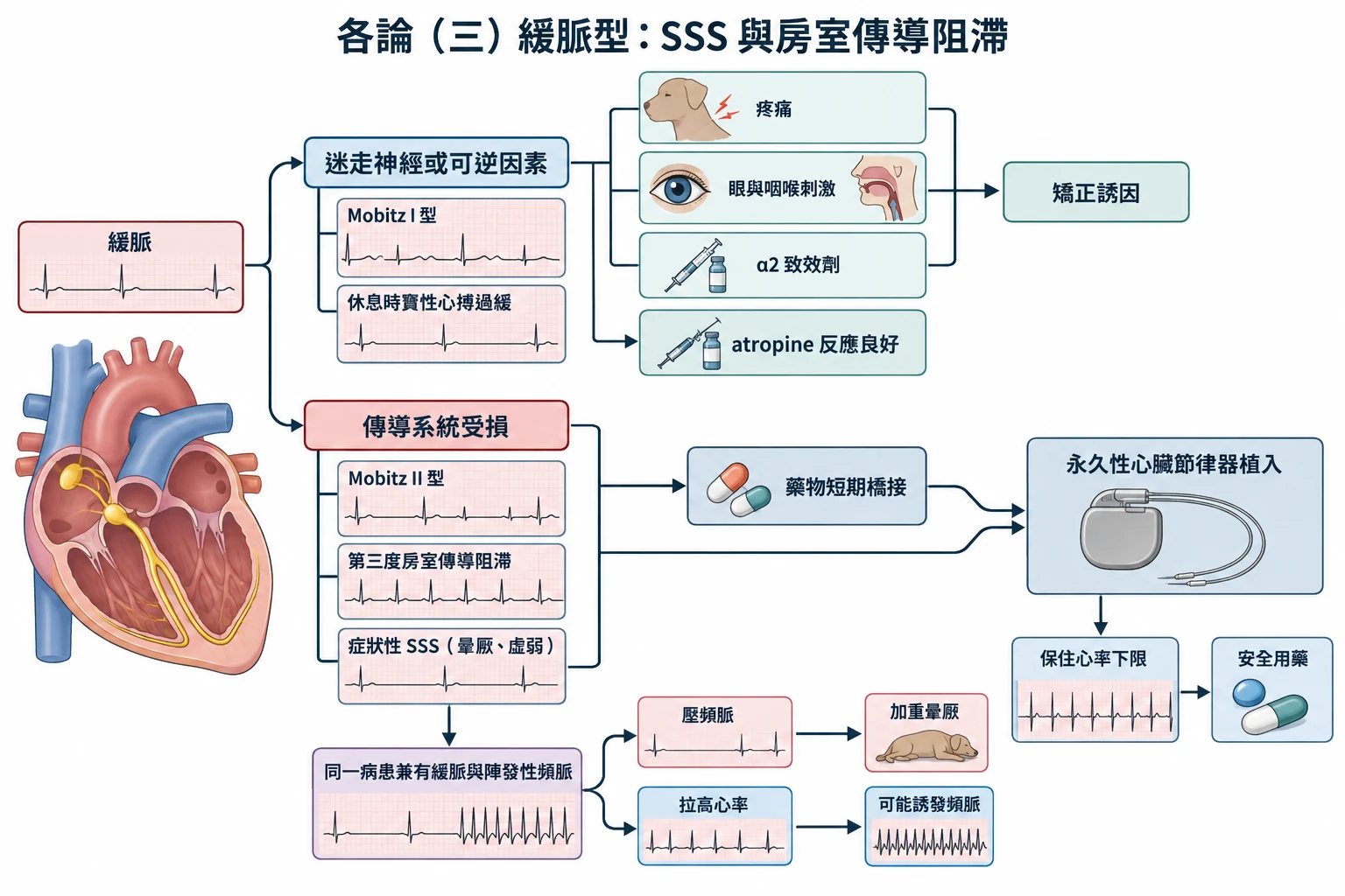 各論(三)緩脈型:SSS 與房室傳導阻滯教學插圖