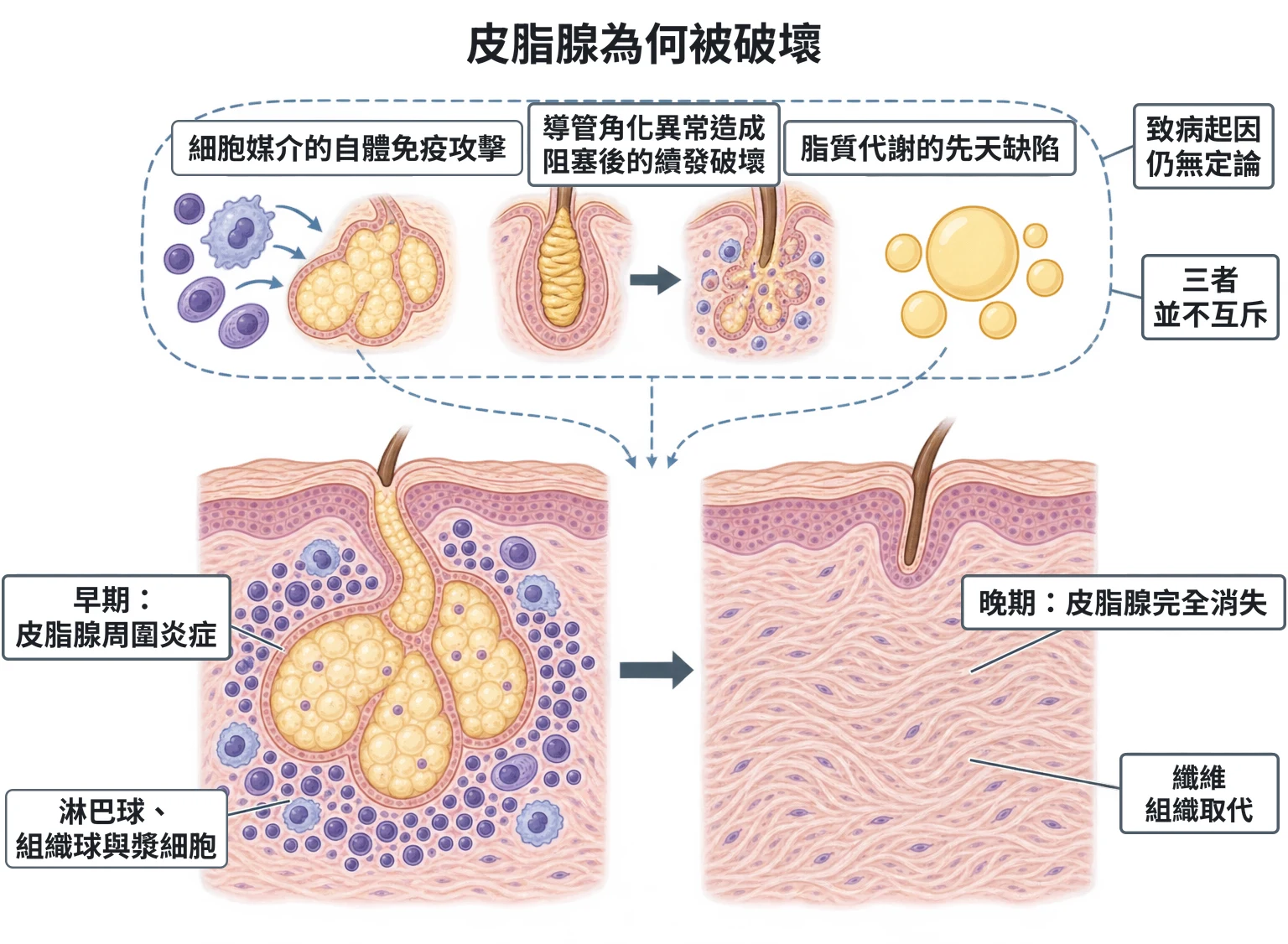 皮脂腺為何被破壞教學插圖