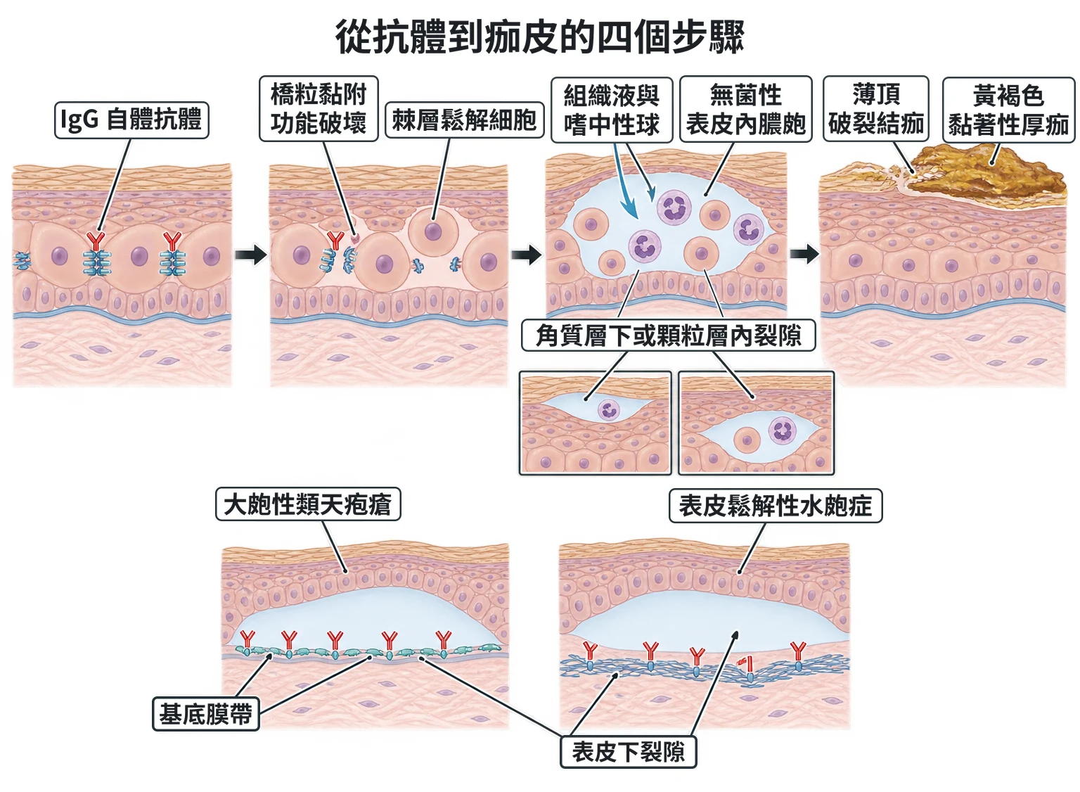 從抗體到痂皮的四個步驟教學插圖