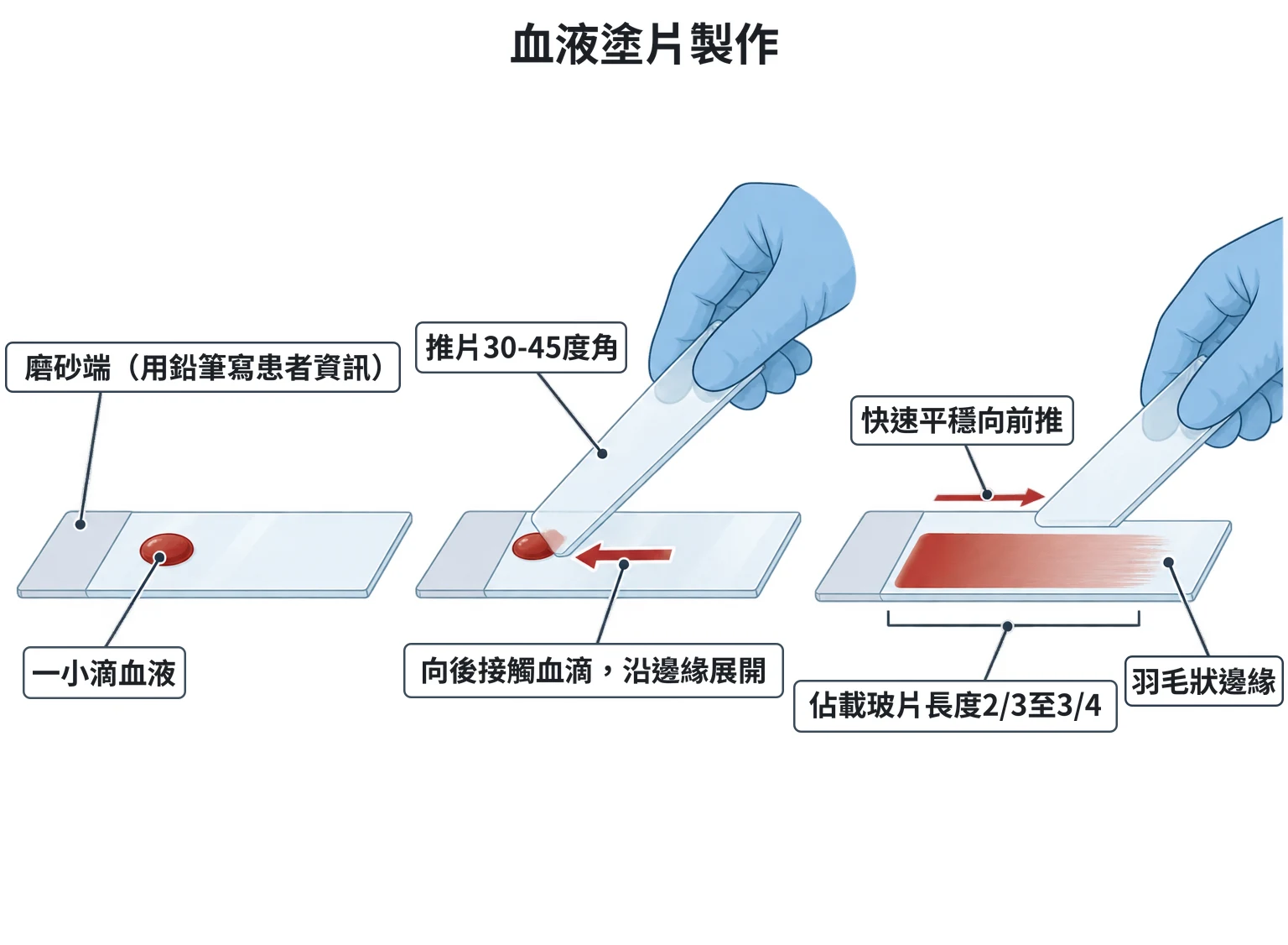 血液塗片製作示意圖：載玻片磨砂端旁滴一小滴血，推片以 30 到 45 度角向後接觸血滴後快速向前推，完成的塗片佔載玻片三分之二到四分之三並有羽毛狀邊緣