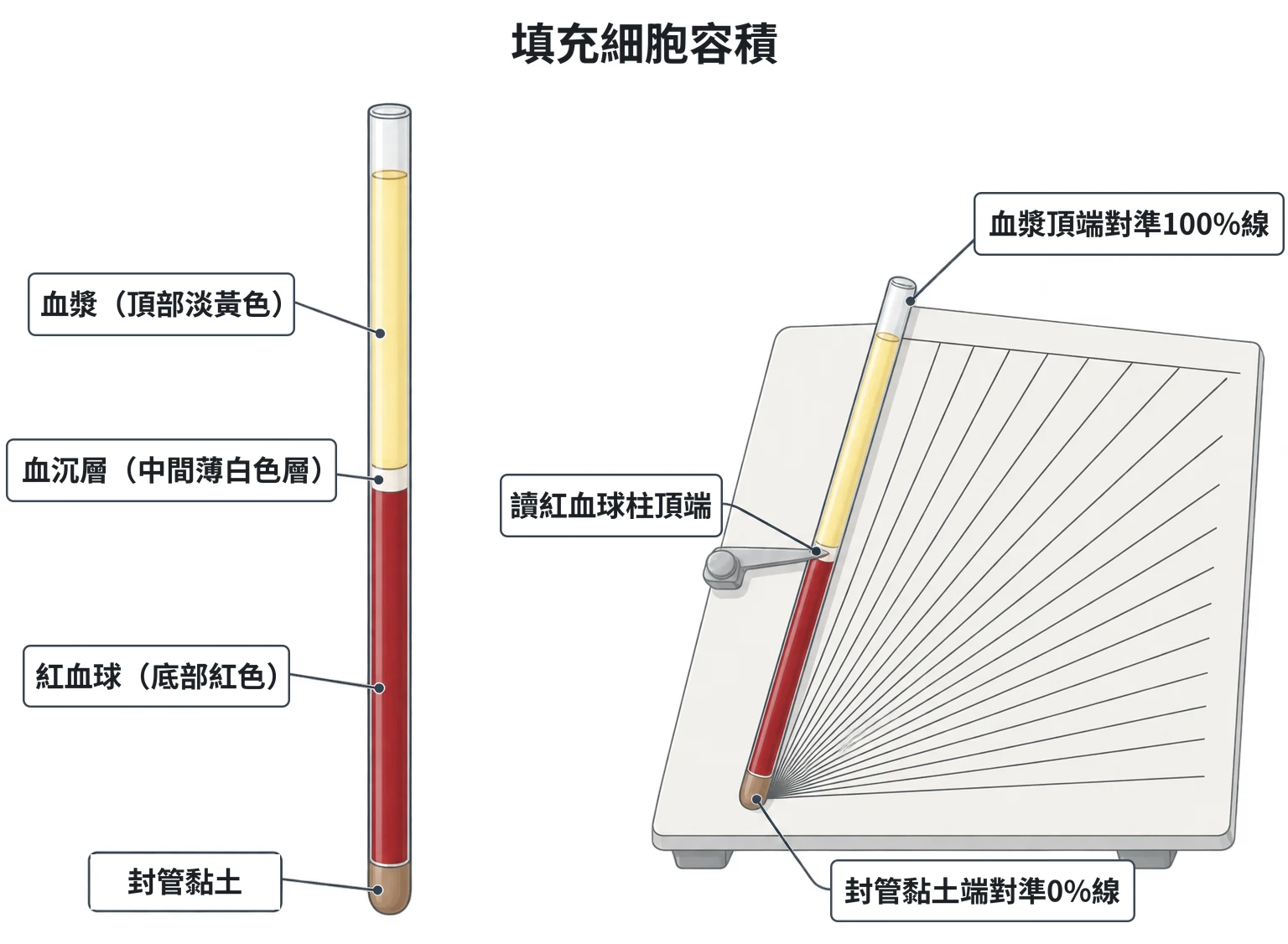 填充細胞容積示意圖：離心後的毛細管由下而上為封管黏土、紅血球、薄白色血沉層、淡黃色血漿；放在讀卡上，黏土端對準 0% 線、血漿頂端對準 100% 線，讀紅血球柱頂端