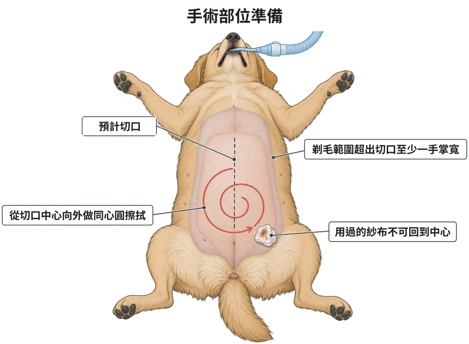 手術部位準備示意圖：仰臥患者的腹部，中線虛線為預計切口，剃毛範圍向外超出至少一個手掌寬；螺旋箭頭從切口中心向外擦拭，用過的紗布在外緣、不回到中心