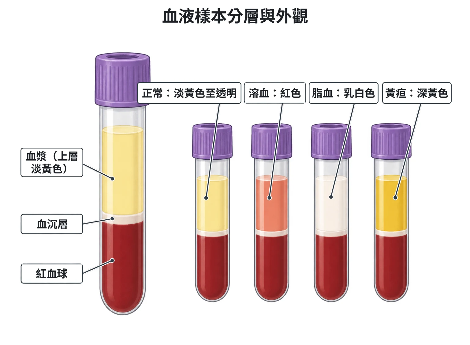 血液樣本成分示意圖：左為離心後的紫頭採血管，由上而下為淡黃色血漿、白色薄層的血沉層、深紅色紅血球；右為四支紫頭管的上層顏色對照：淡黃透明、紅色、乳白色、深黃色